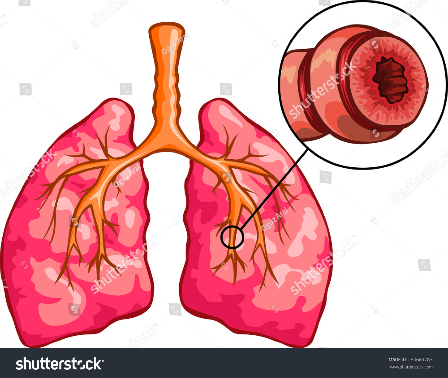 Vector Illustration Human Lungs Asthma Disease Stock Vector Royalty Free 280664783 Shutterstock