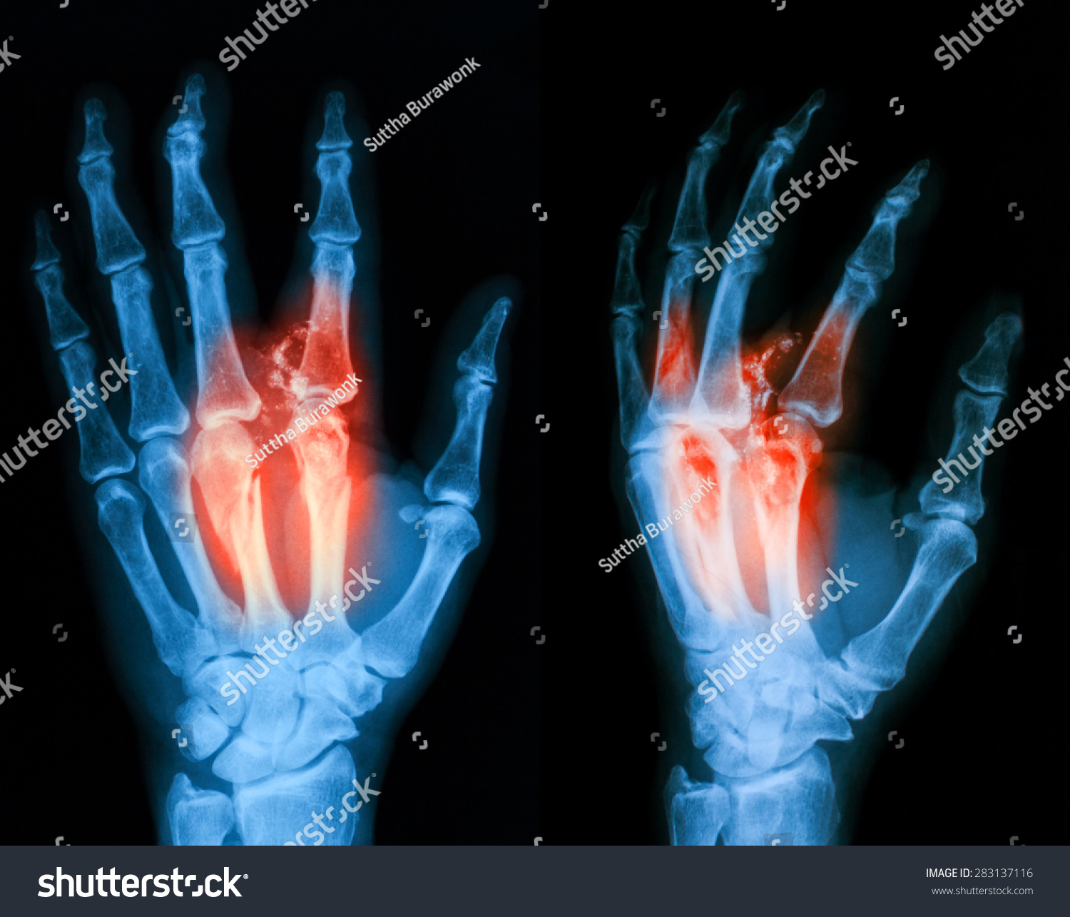 Xray Image Hand Pa Oblique View Stock Photo 283137116 | Shutterstock