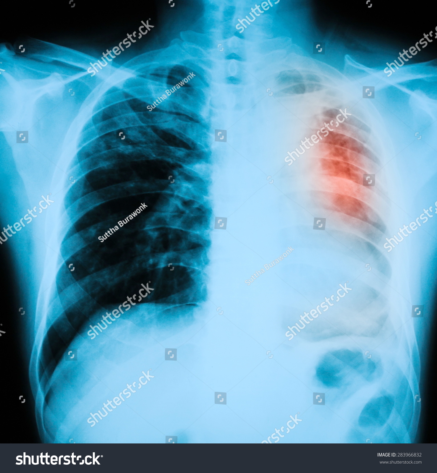 Chest Xray Pa Upright Position Shows Stock Photo 283966832 | Shutterstock