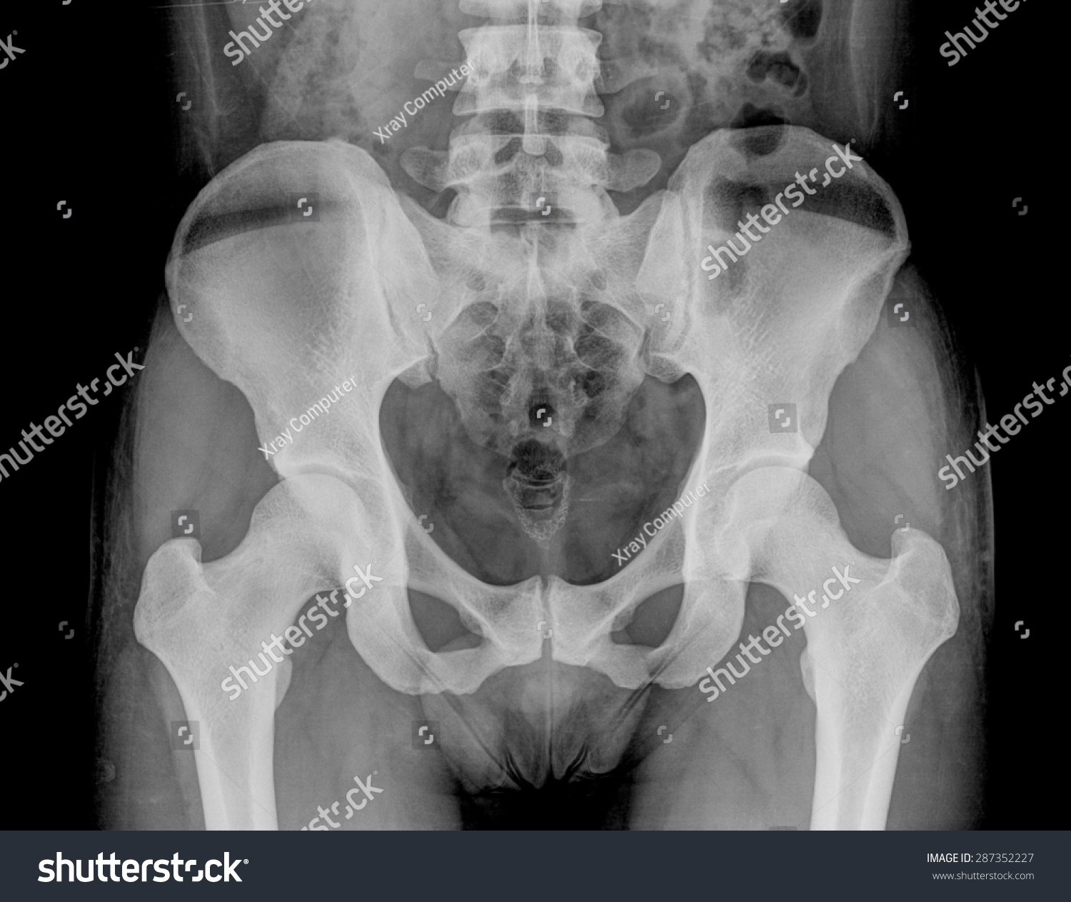 Лобковая кость рентген