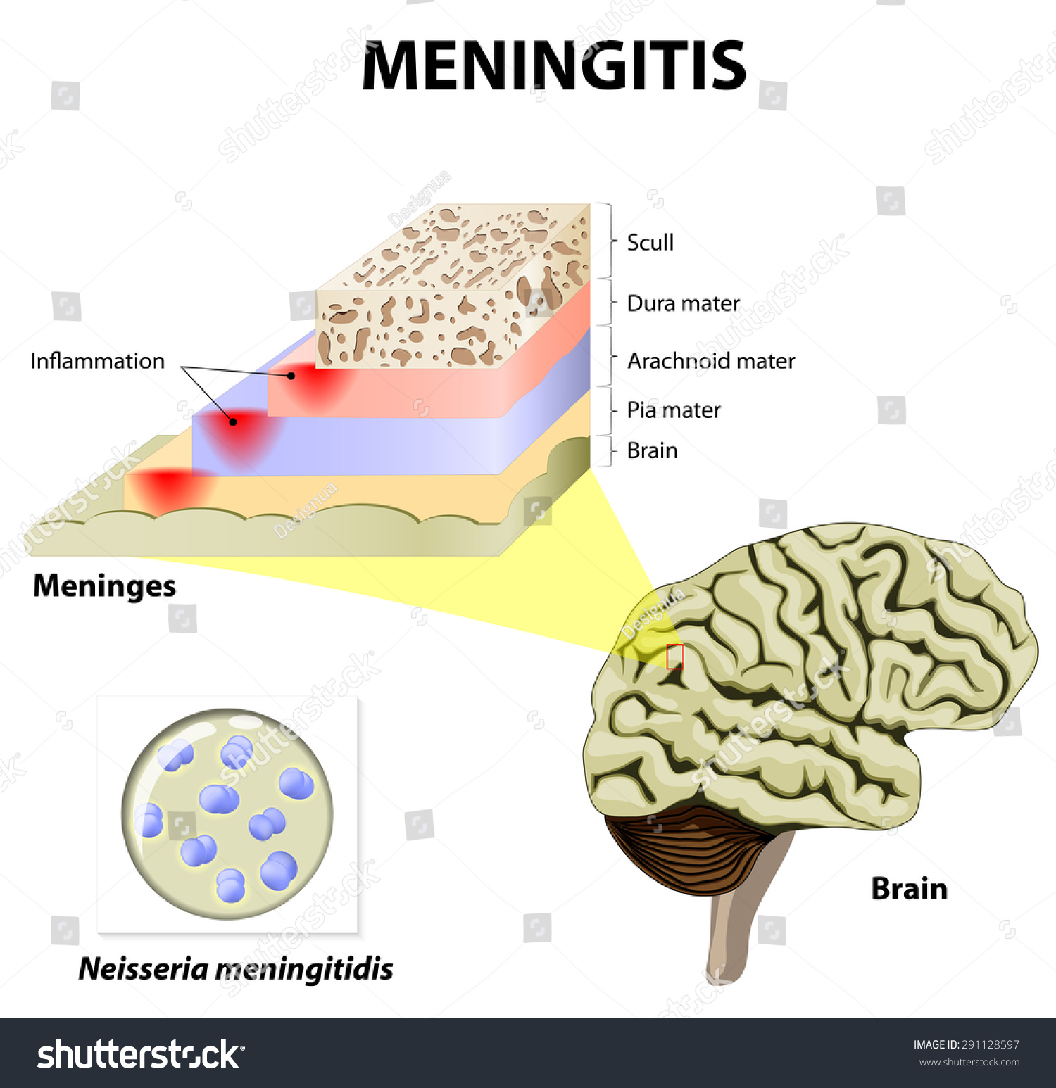 Meningitis Human Brain Meningococcal Bacteria Meninges Stock Vector ...