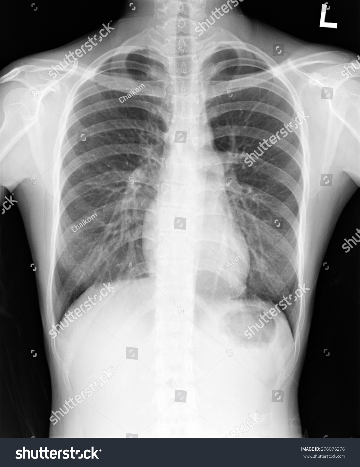 Xray Human Torax Isolated Stock Photo 296076296 | Shutterstock