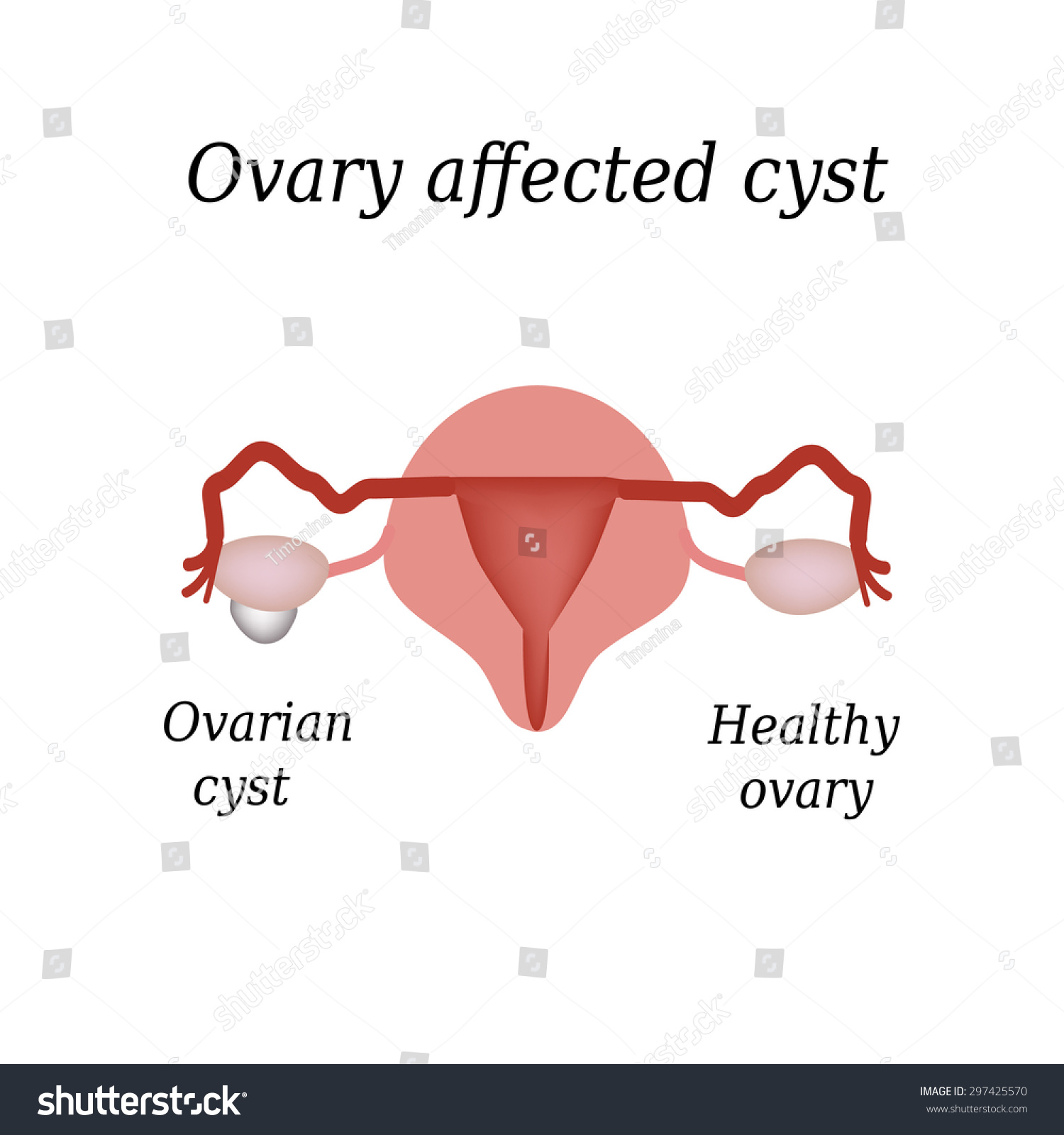 Cyst Ovary Pelvic Organs Stock Illustration 297425570 | Shutterstock
