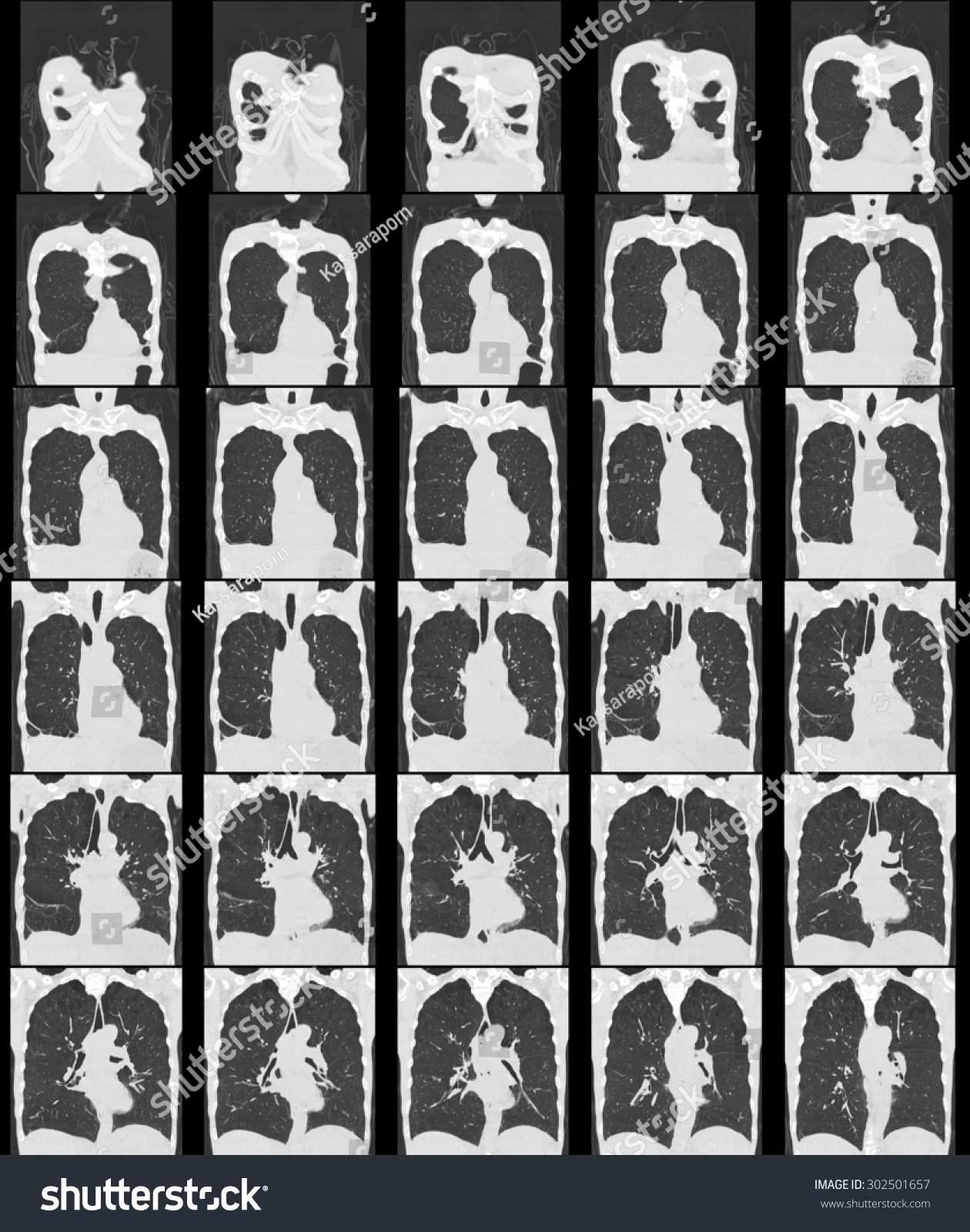 Computer Tomography Chest Abdomen Ct Scan Stock Photo 302501657 ...