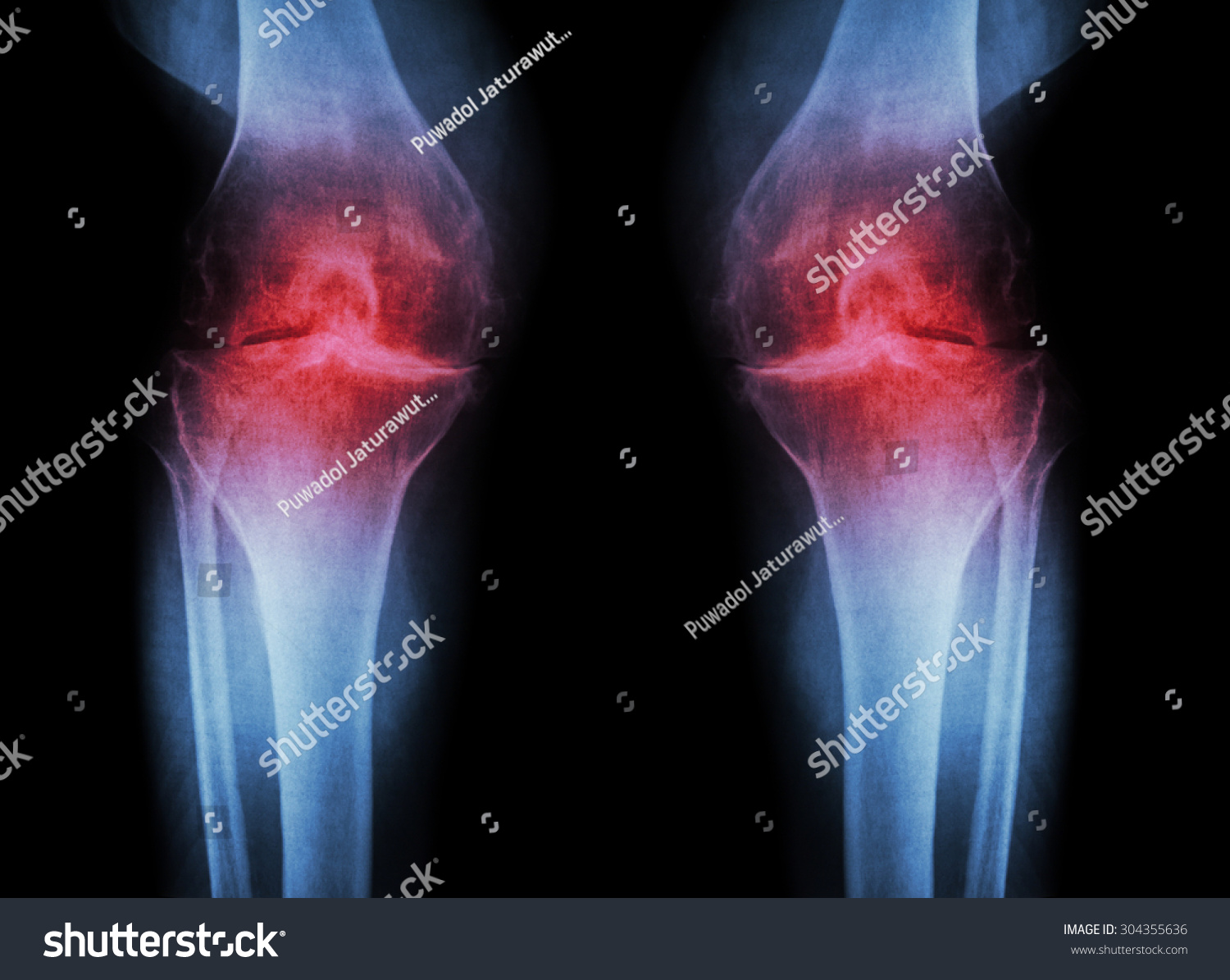 Osteoarthritis Knee Oa Knee Film Xray Stock Photo 304355636 | Shutterstock