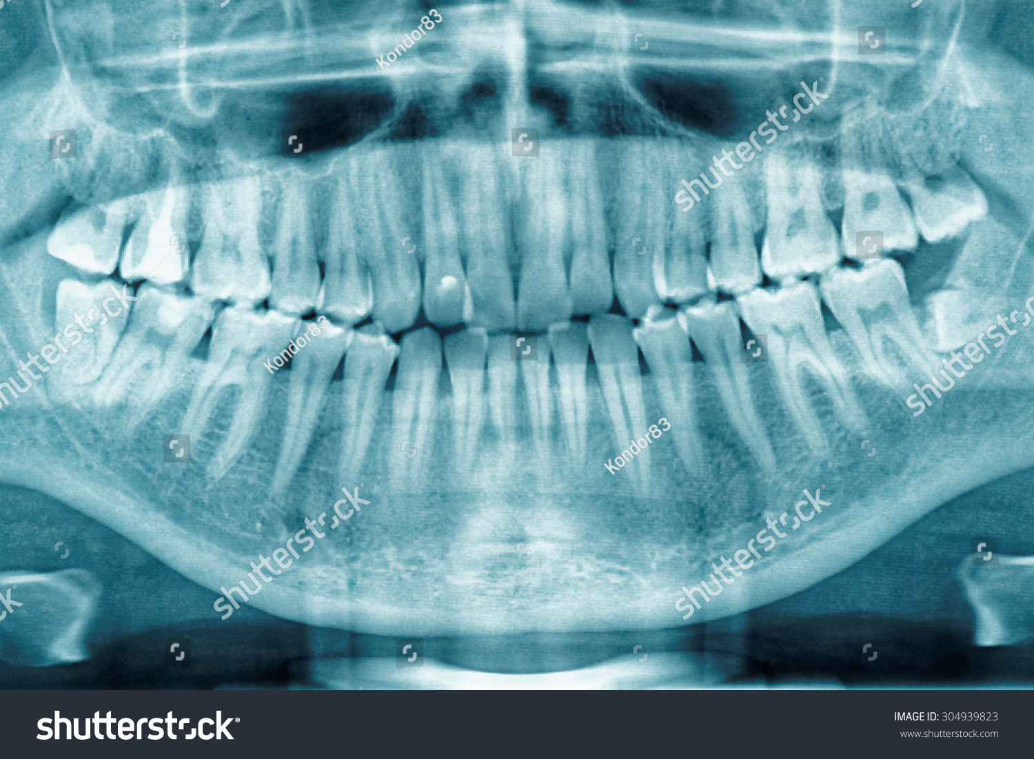 Panoramic Dental Xray Fully Impacted Wisdom Stock Photo 304939823 ...