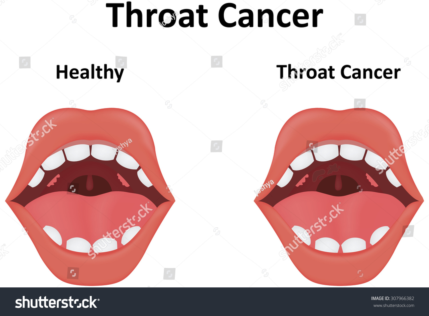 Throat Cancer Stock Illustration 307966382 | Shutterstock