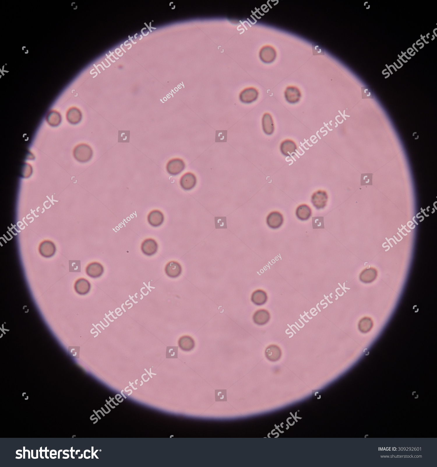 Fresh Red Blood Cells In Urine Specimen Under Microscope X Stock Sexiz Pix