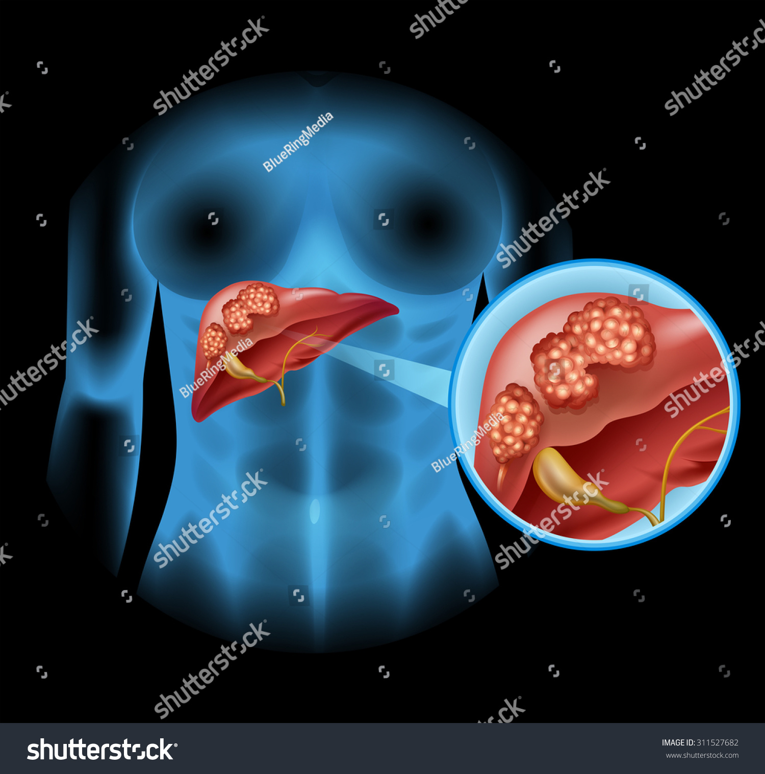 Liver Cancer Diagram Detail Illustration Stock Vector (Royalty Free ...