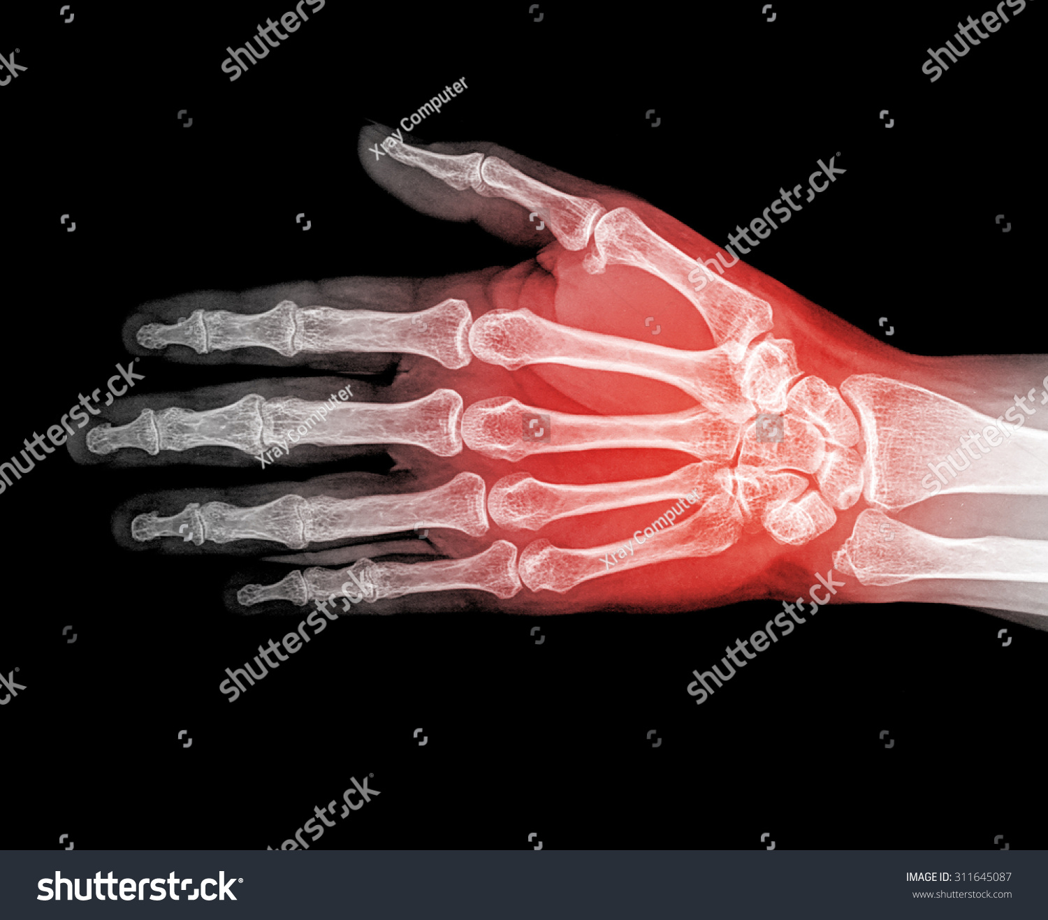 Hand Xray Image Medical Background Stock Photo 311645087 