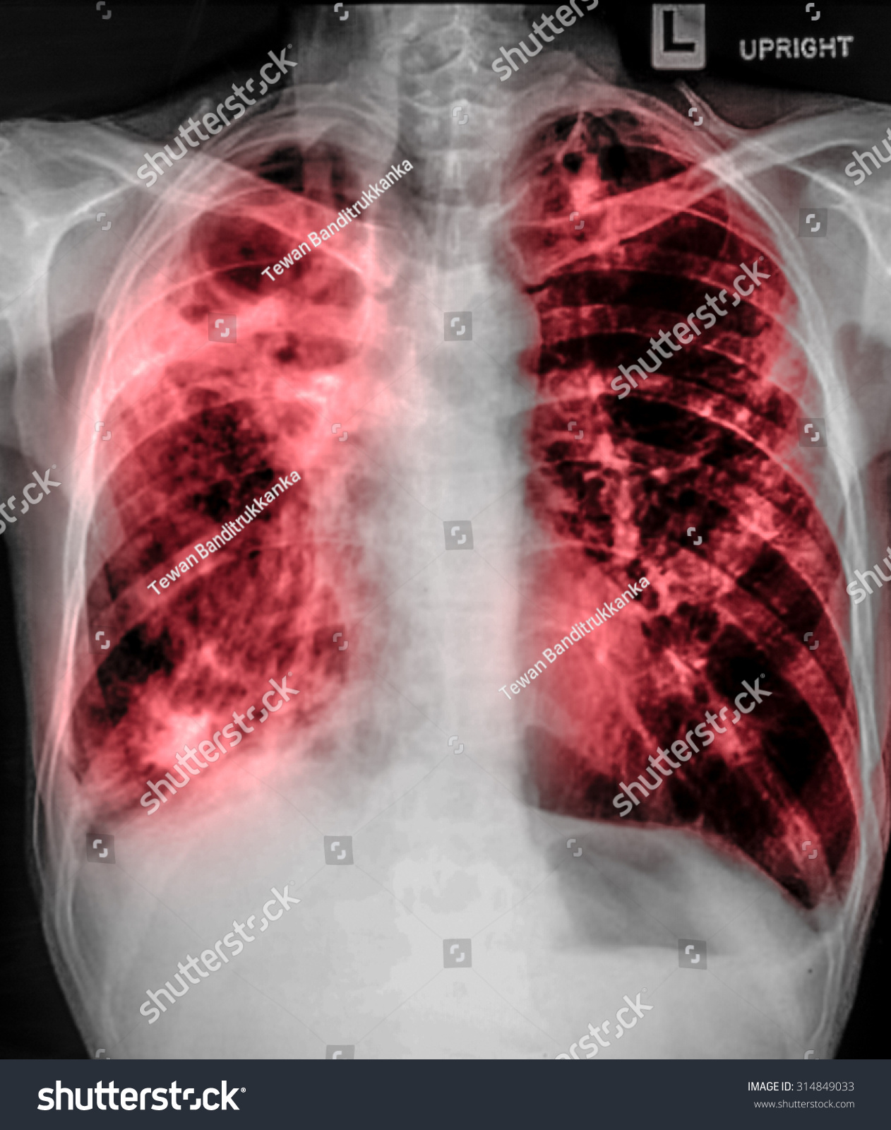 Chest Xray Showing Infiltrate Lung Pneumonia Stock Photo 314849033 ...