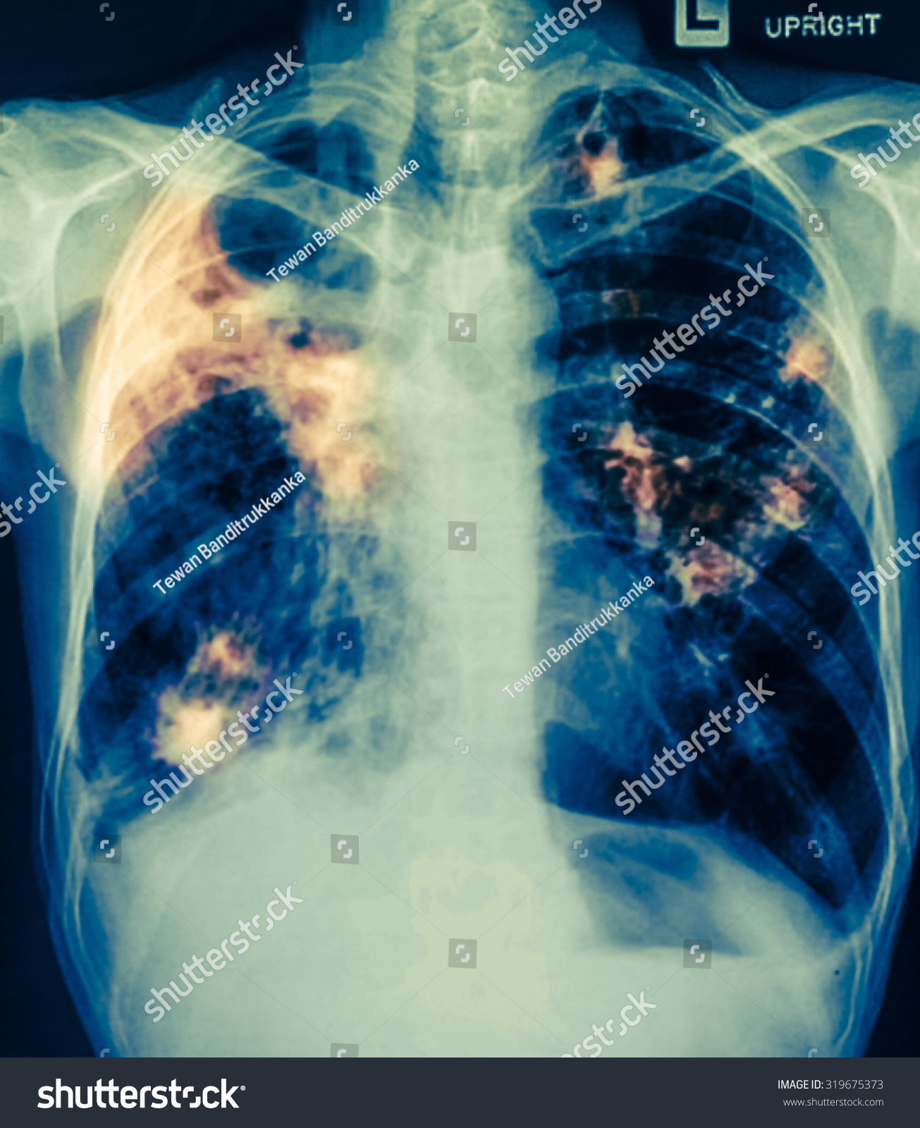 Chest Xray Showing Infiltrate Lung Pneumonia Stock Photo 319675373 ...