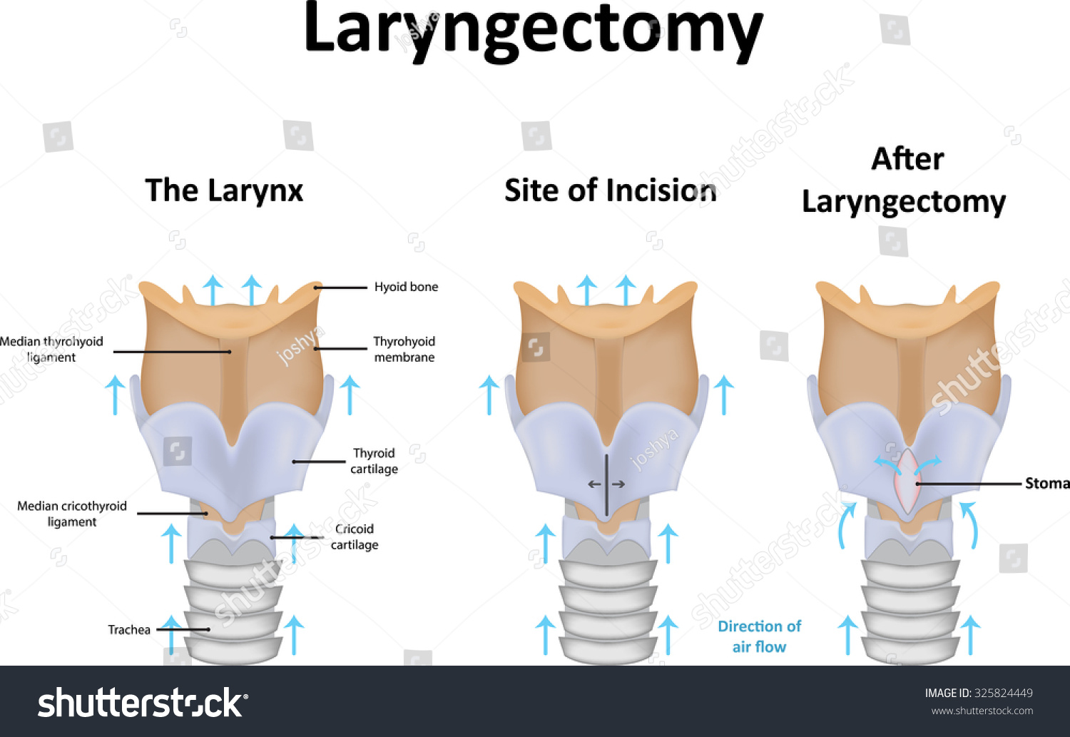 2 Total Laryngectomy Images, Stock Photos & Vectors | Shutterstock