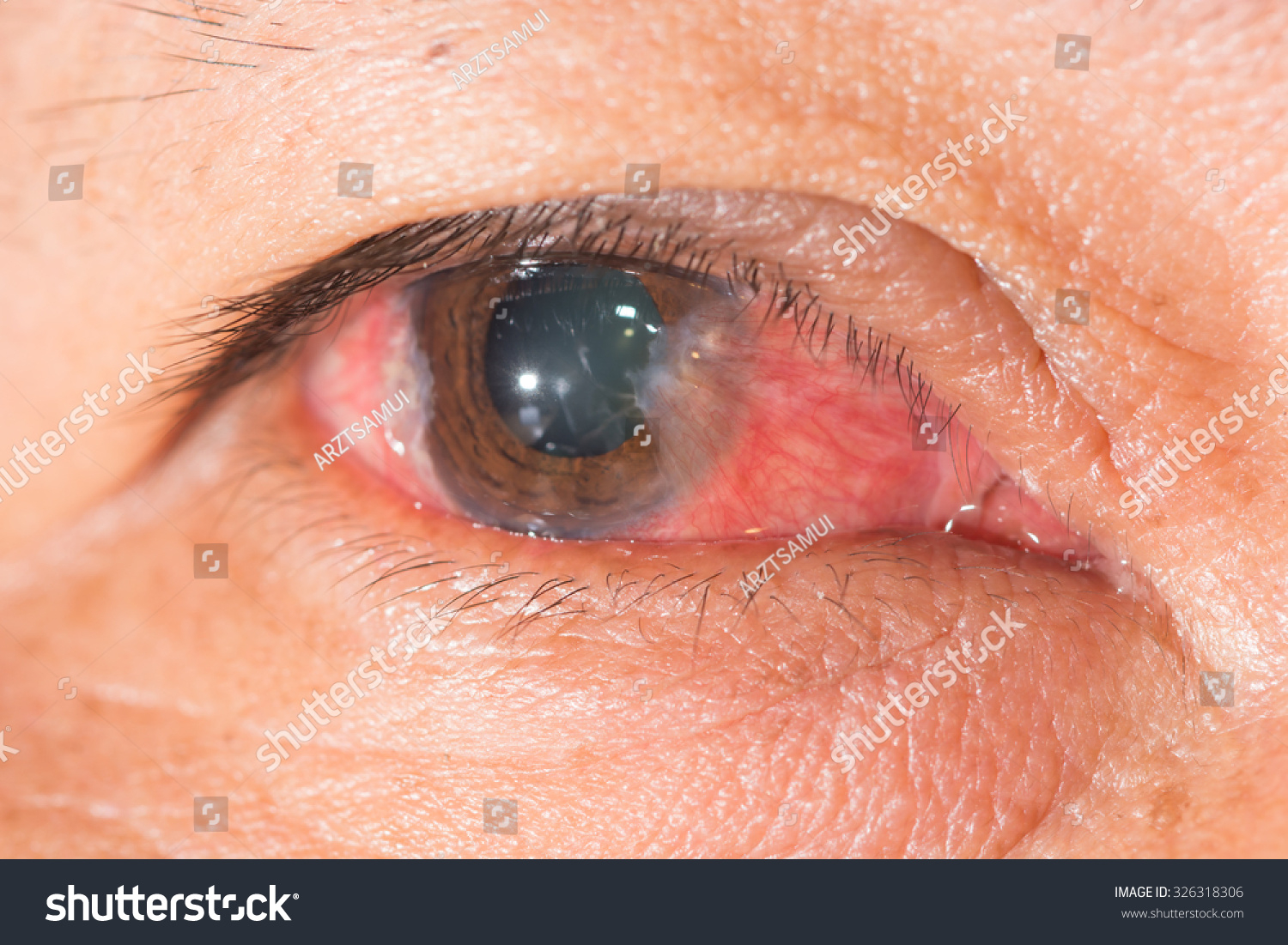 Close Advance Pterygium During Eye Examination Stock Photo 326318306 ...