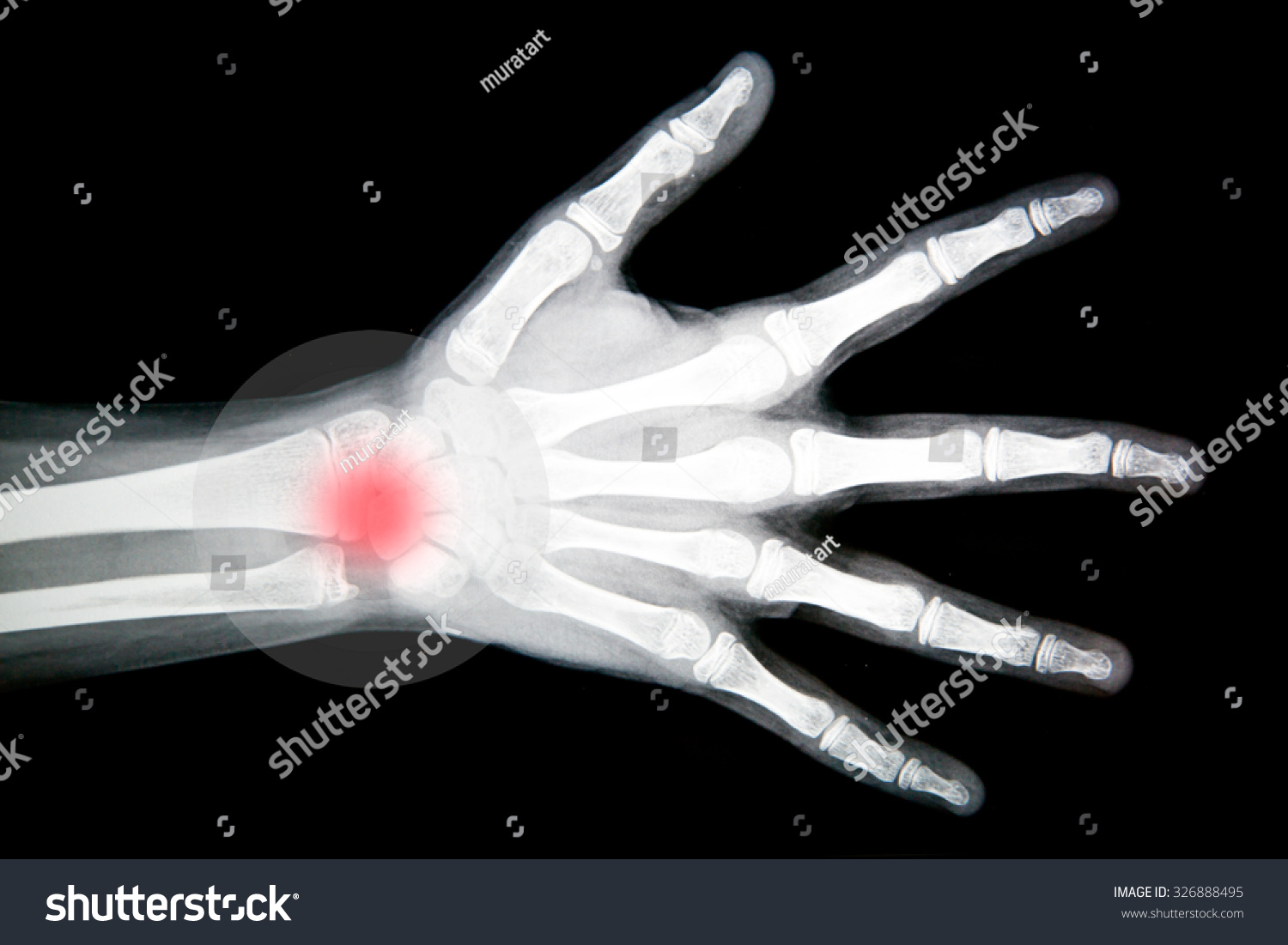 Xray Hand Fractures Stock Photo 326888495 | Shutterstock