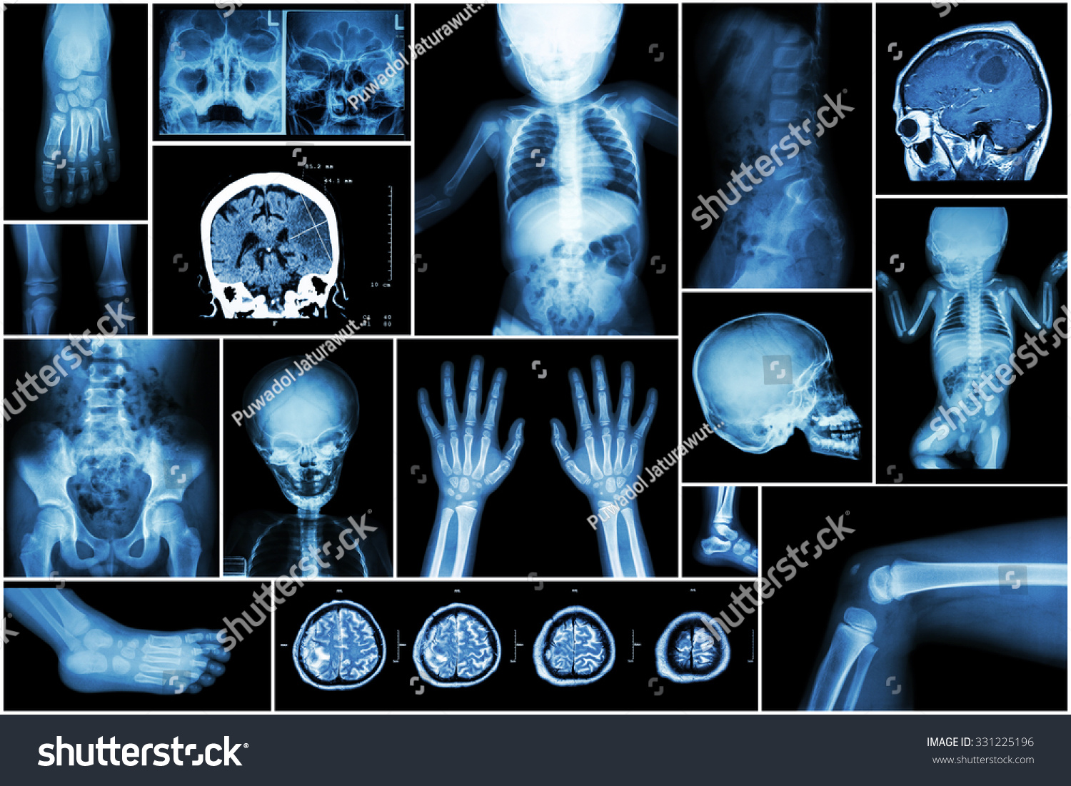 23 Brain Tumor In Baby Images, Stock Photos & Vectors | Shutterstock