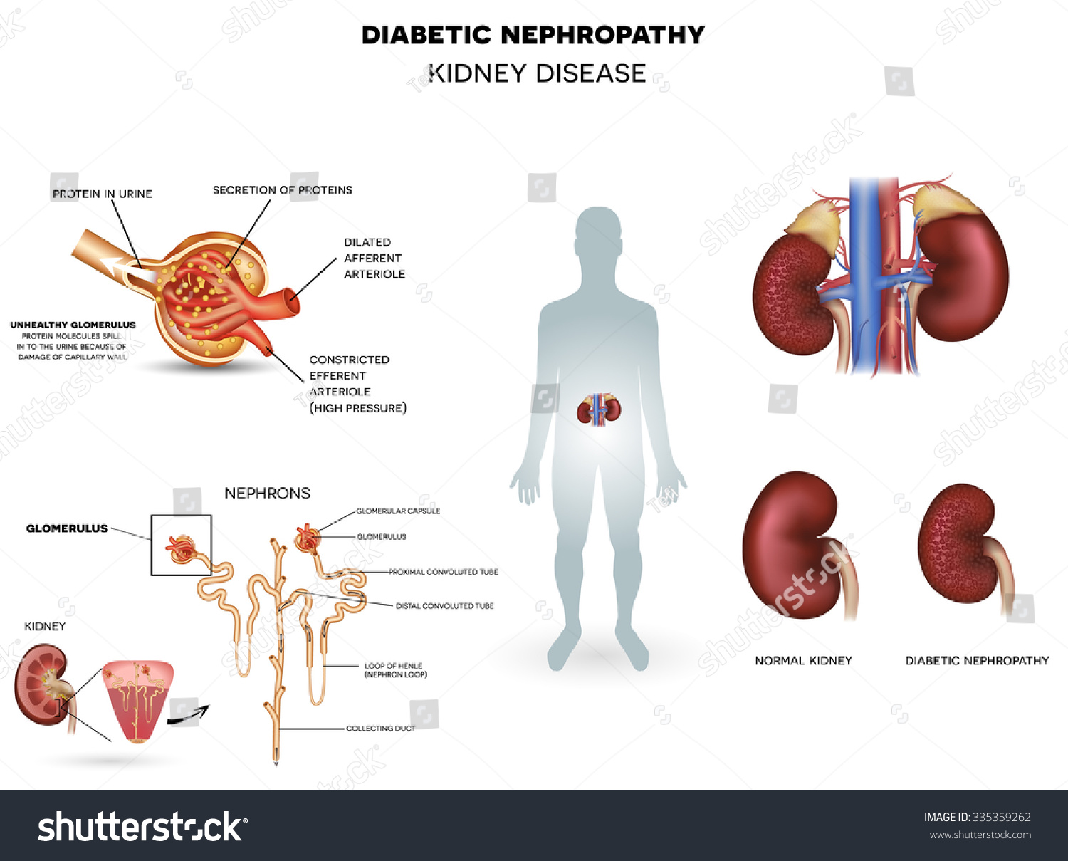 Nephropathy Kidney Disease Caused By Diabetes Stock Illustration 