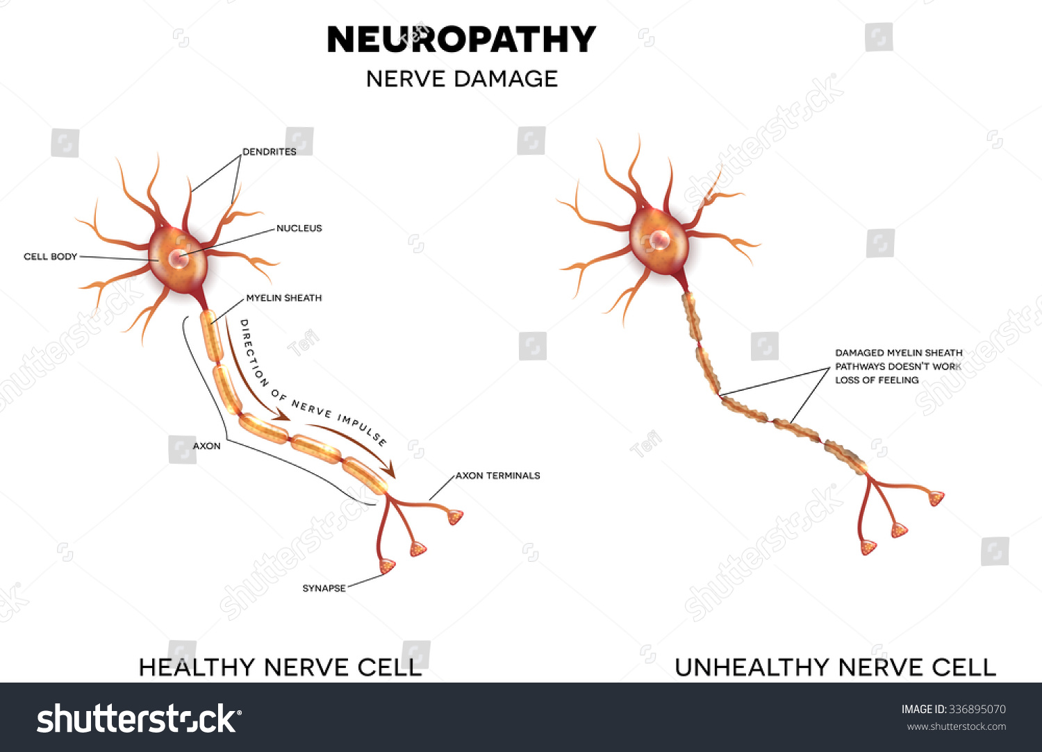1 067 Neuron Damage Images Stock Photos Vectors Shutterstock 1 067 Neuron Damage Images Stock Photos Vectors Shutterstock