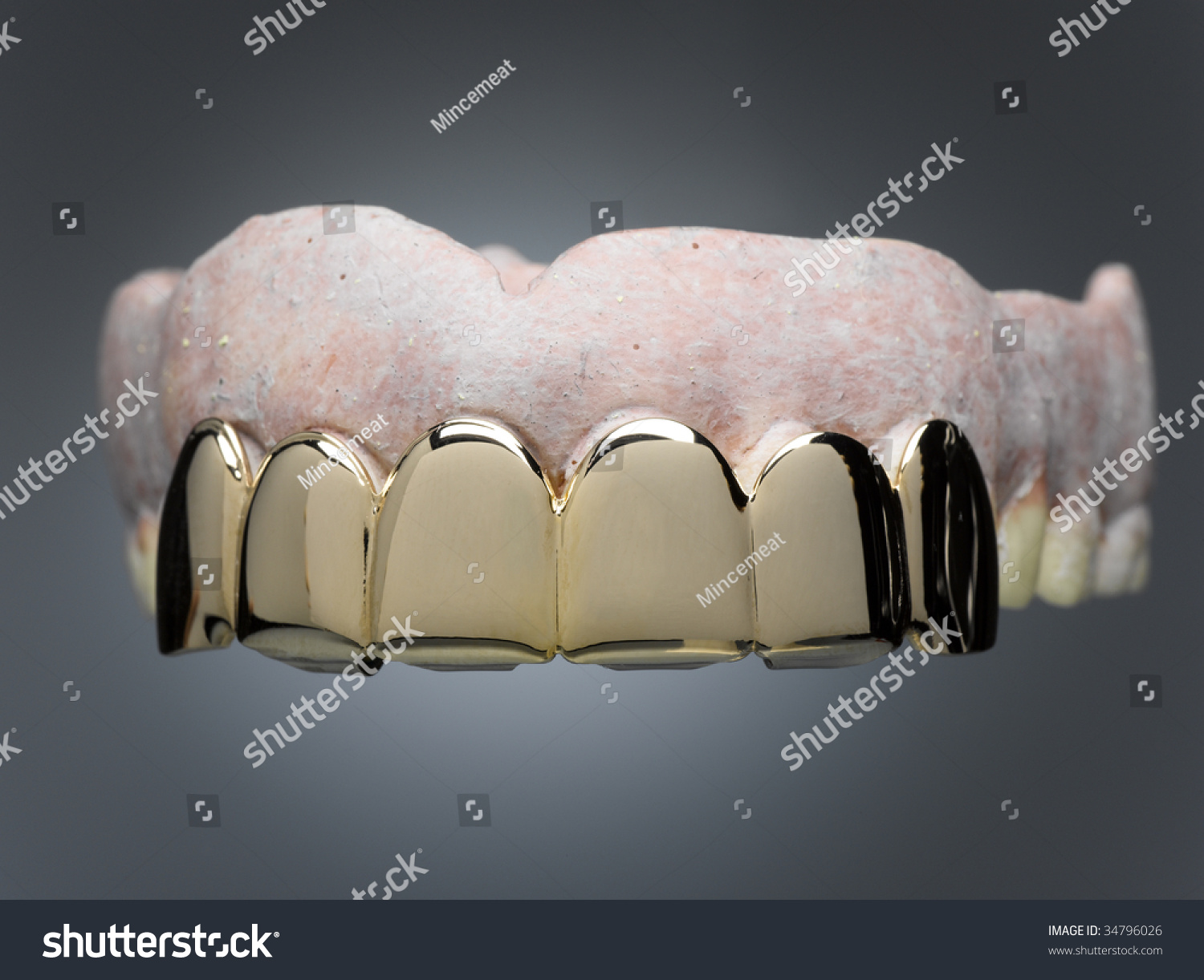 зубной мост из циркония