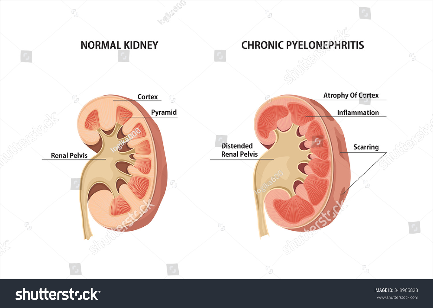 Normal Kidney Chronic Pyelonephritis Stock Illustration 348965828 ...