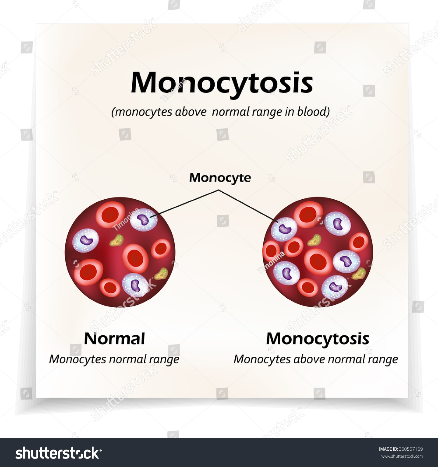 monocytes-above-normal-range-blood-monocytosis