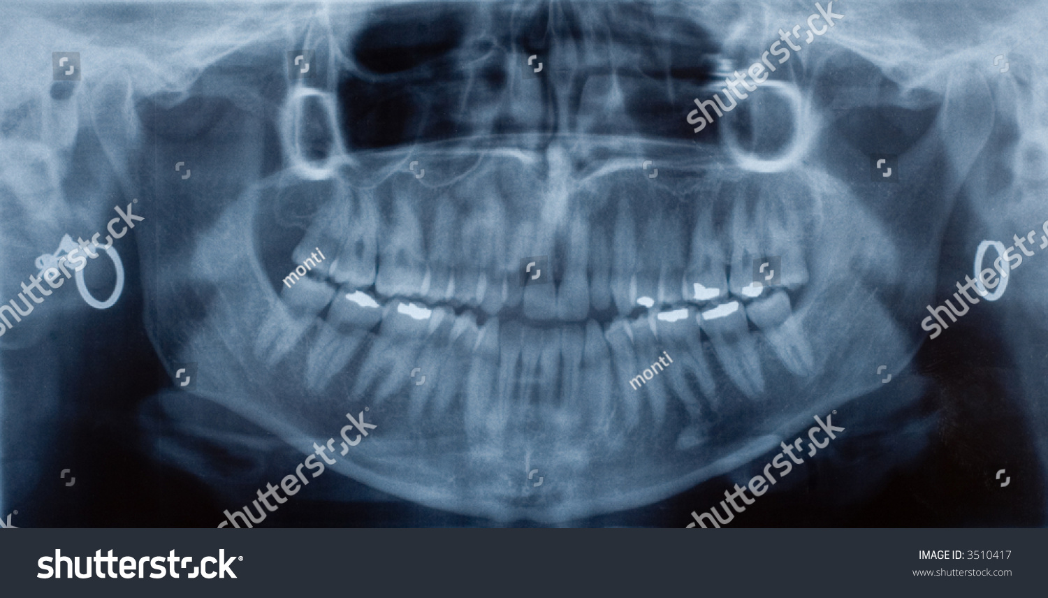 Female Dental Xray Showing Teeth Fillings Stock Photo 3510417 ...