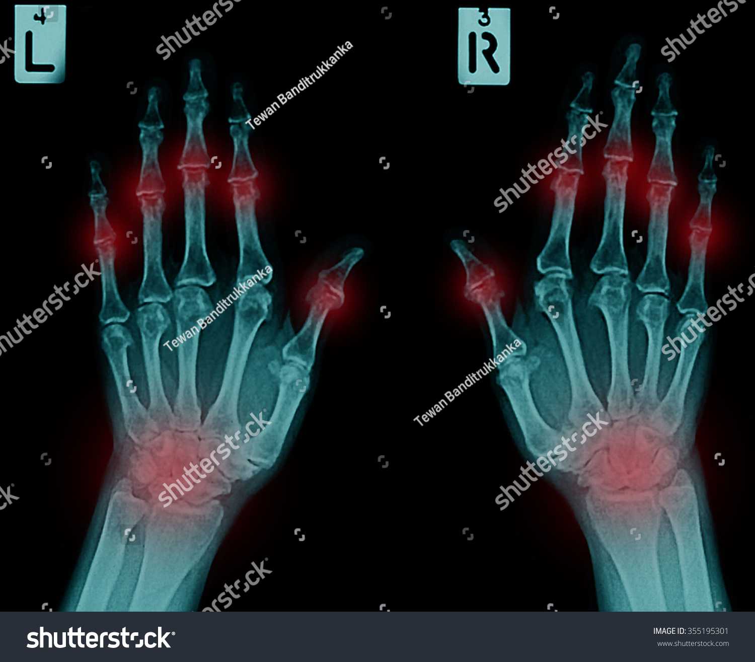 Film Xray Both Humans Hands Arthritis Stock Photo 355195301 | Shutterstock