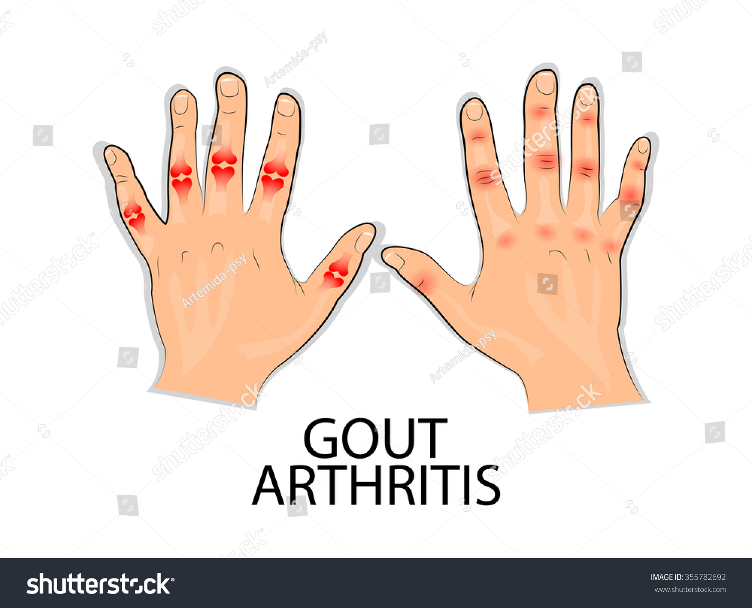 Development Gout Pain Joints Stock Vector (Royalty Free) 355782692 ...