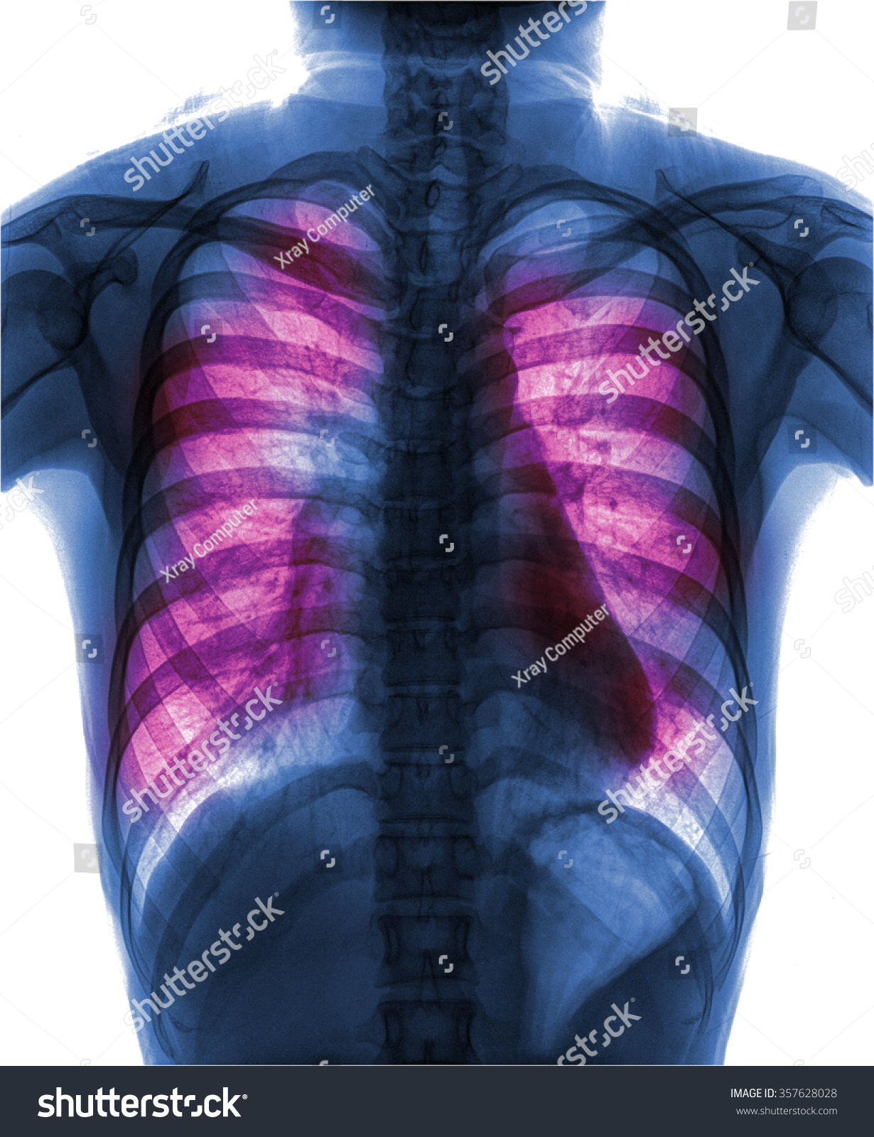 Pulmonary Tuberculosis Chest Xray Interstitial Infiltration Stock Photo ...