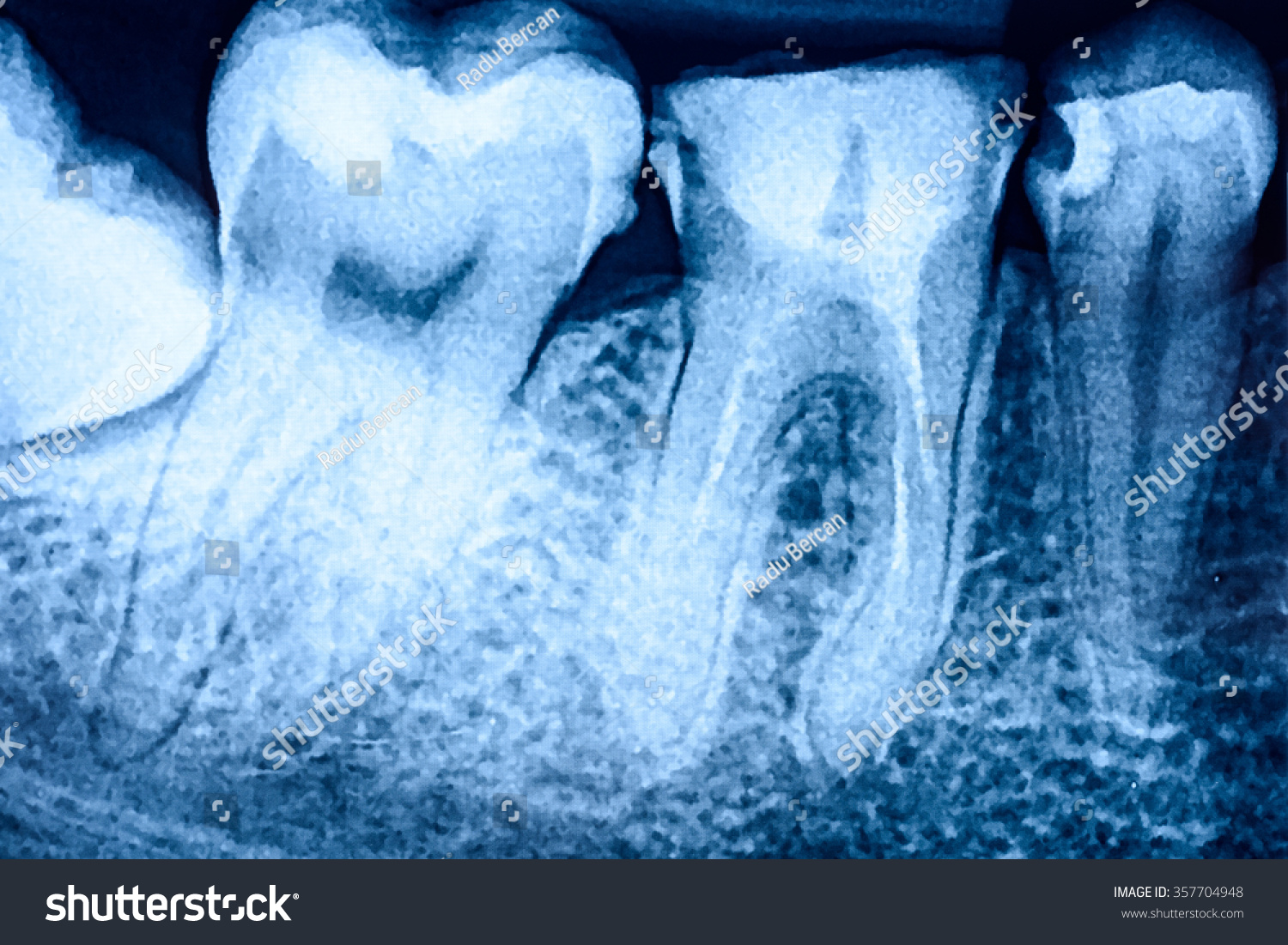 Tooth Decay On Xray Stock Photo 357704948 | Shutterstock