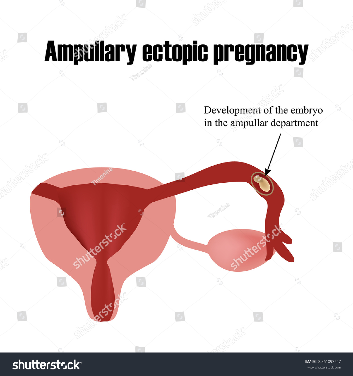 Development Embryo Ampullar Department Ectopic Pregnancy Stock Vector