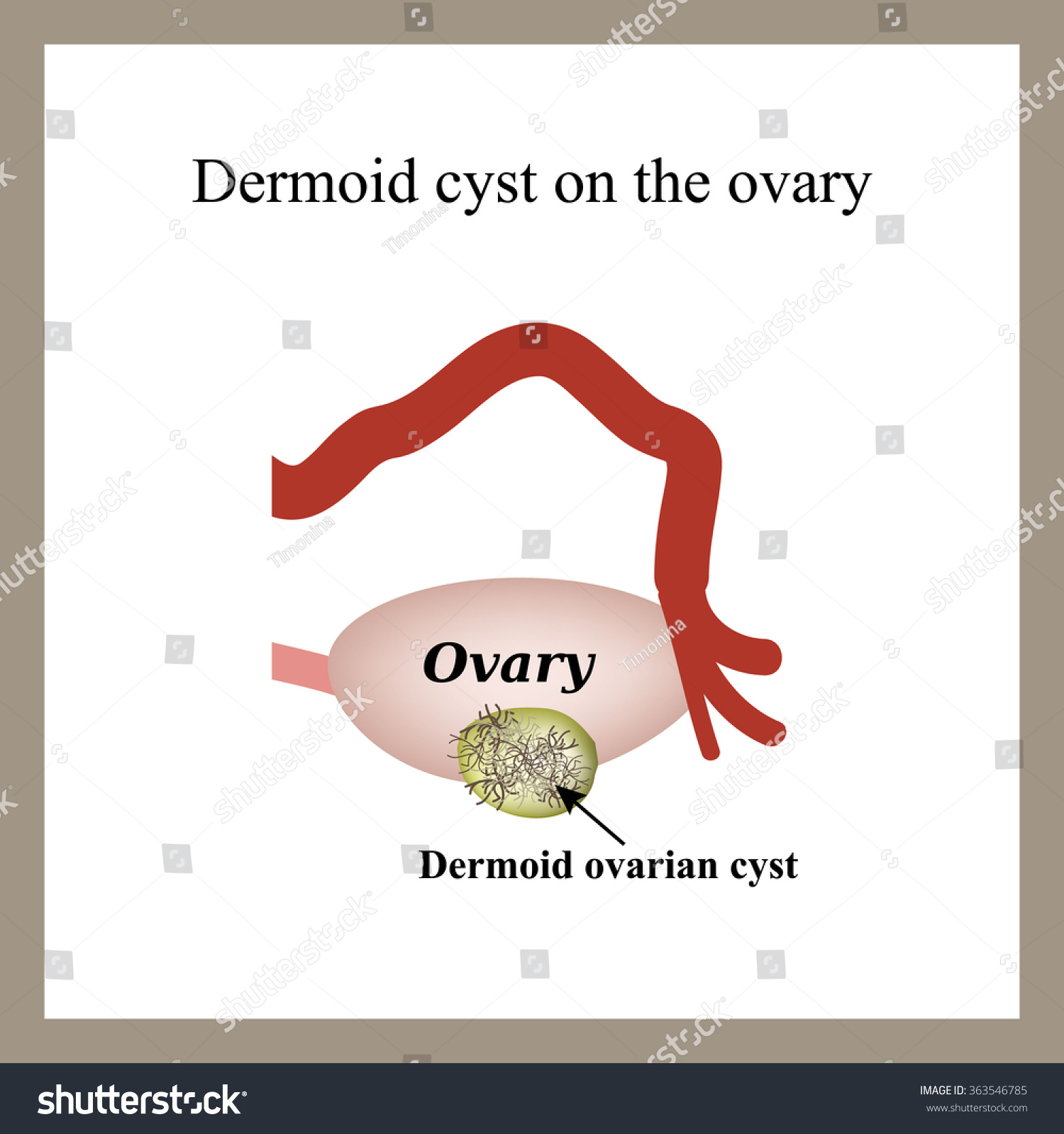 Dermoid Cyst On Ovary Ovary Infographics Stock Vector (Royalty Free ...