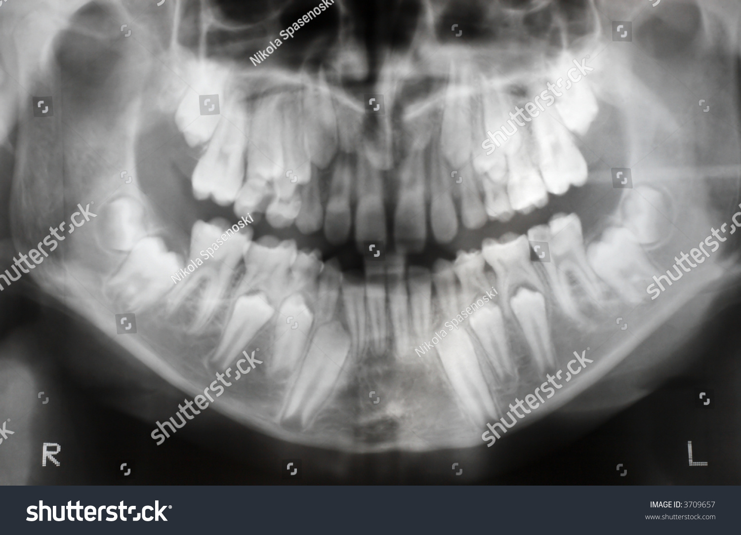 Рентген челюсти молочных зубов