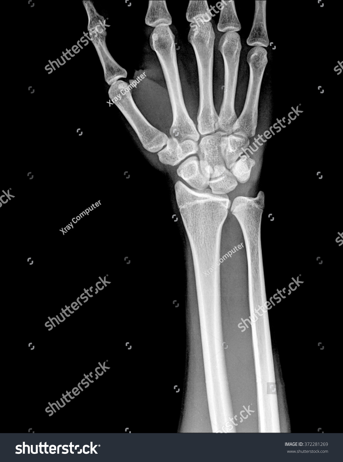 Fracture Distal Radius Wrist Bone Stock Photo 372281269 | Shutterstock