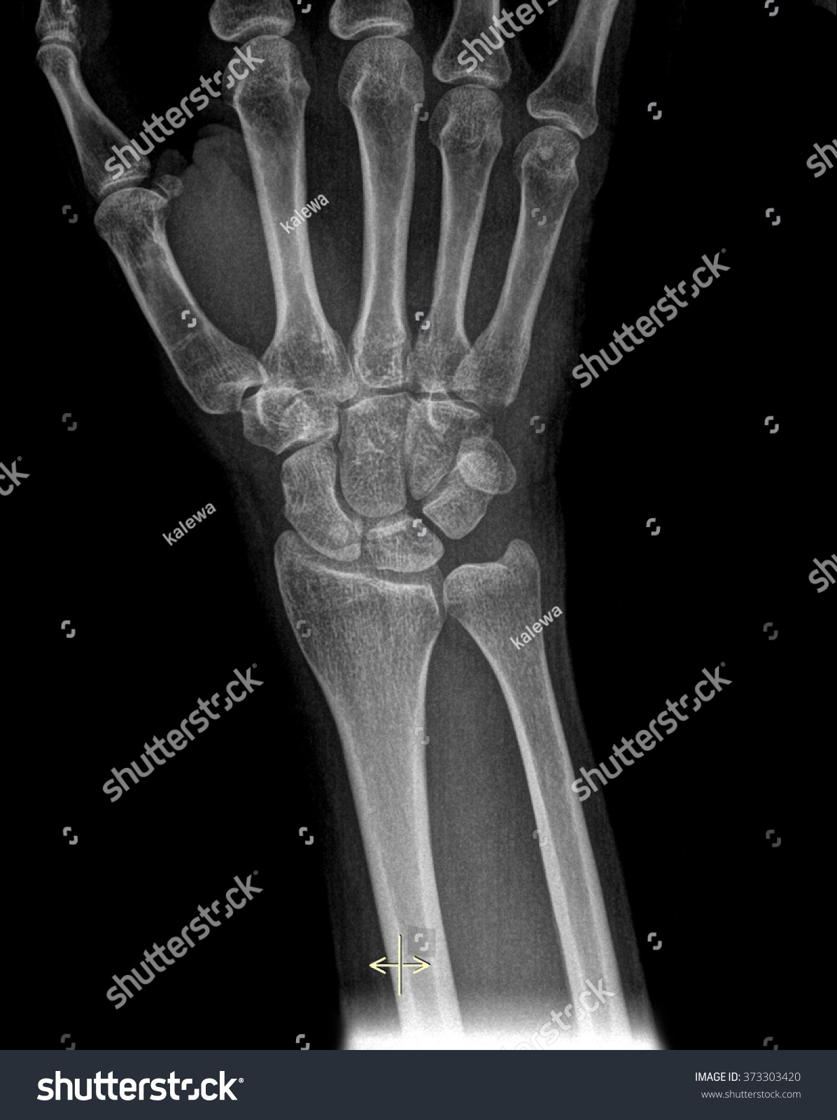 Human Wrist On Roentgenogram Anterior View Stock Photo 373303420 ...