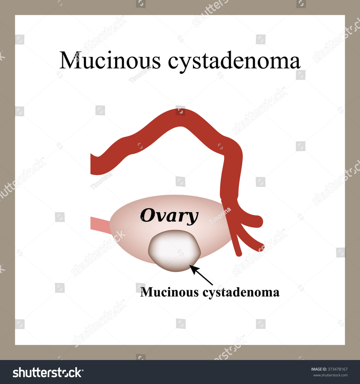 Mucinous Cyst On Ovary Cystadenoma Ovary Stock Illustration 373478167 Shutterstock 0663