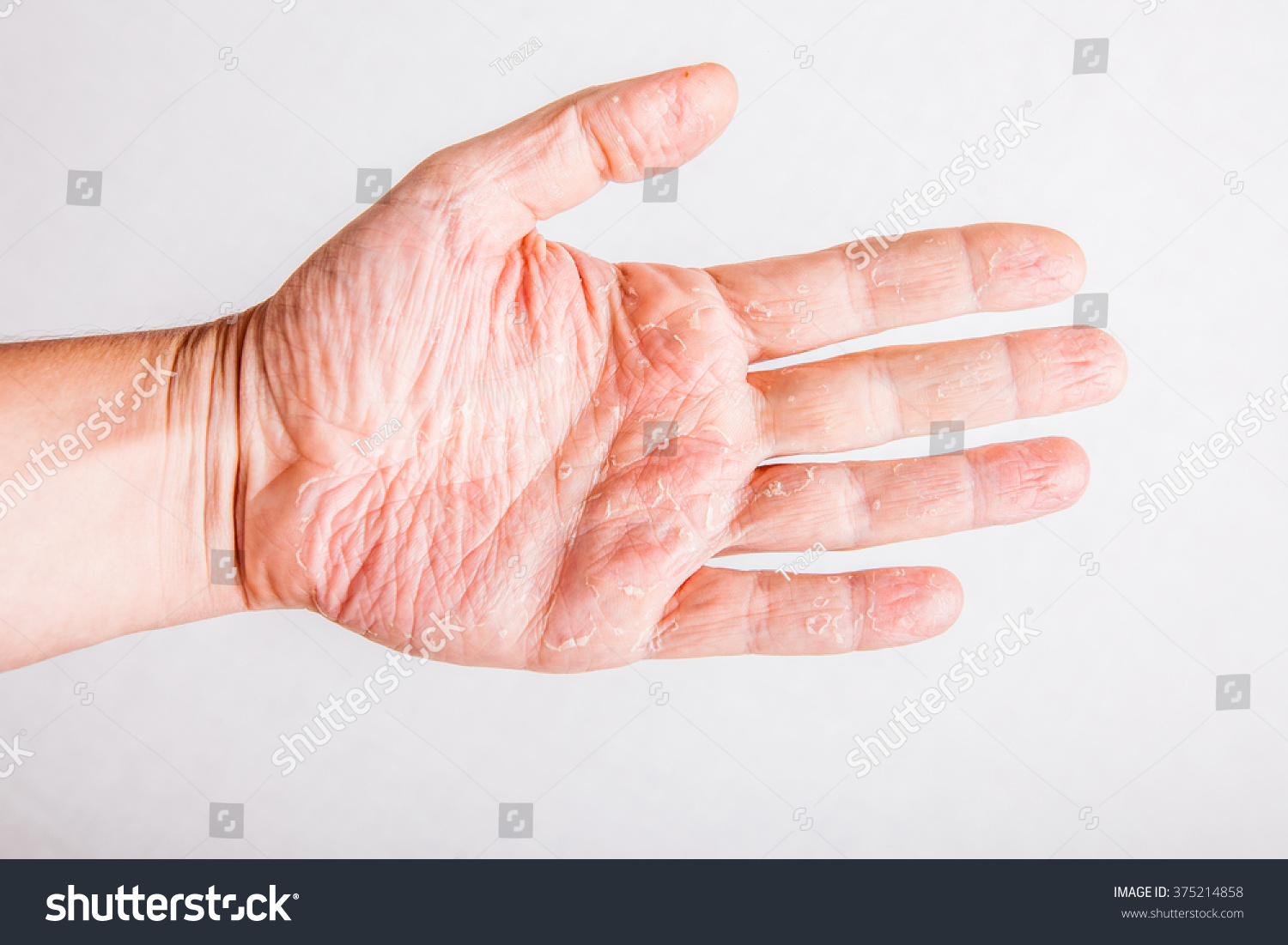 Eczema Atopic Dermatitis Symptom Skin Texture Foto Stock 375214858