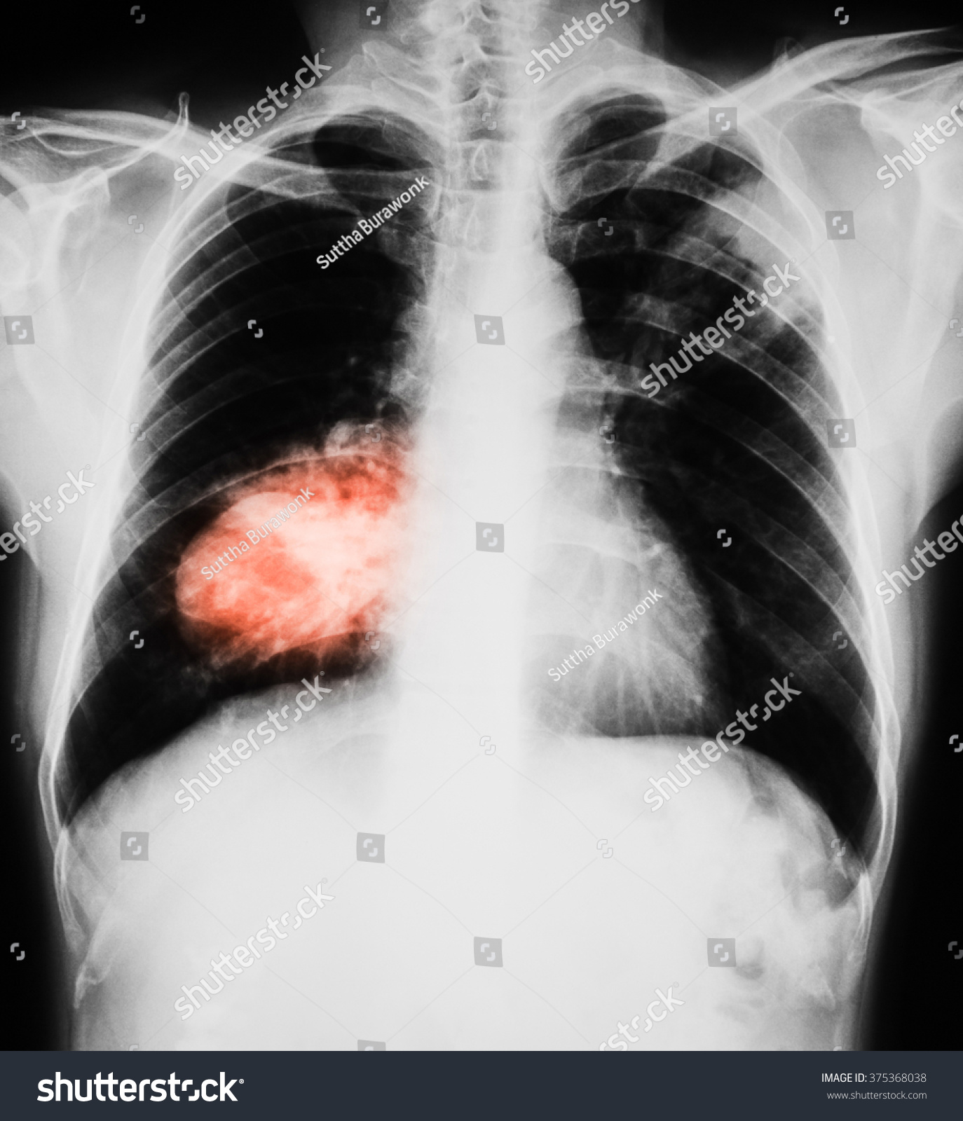 Chest Xray Image Shows Huge Isolated Stock Photo 375368038 | Shutterstock