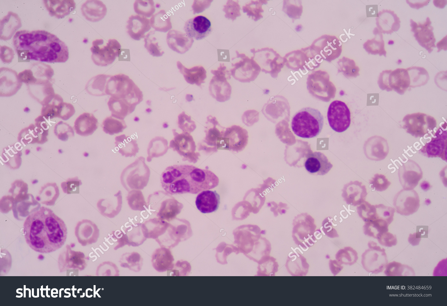 Blood Smear Patients Anemia Showing Abnormal Stock Photo 382484659 ...