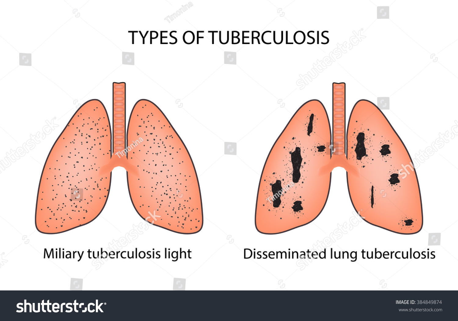 Легкие больного туберкулезом и здорового