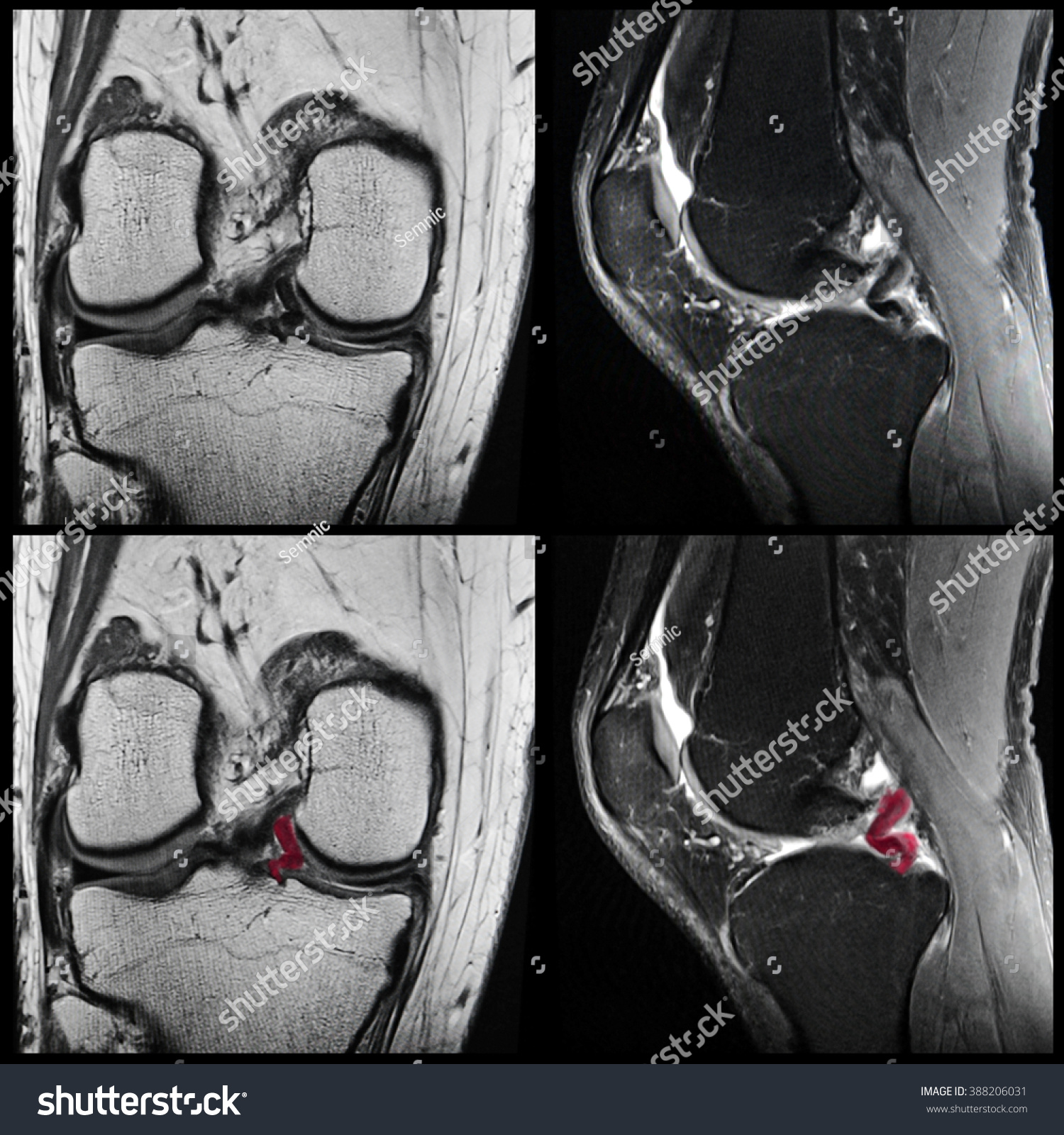 Knee Meniscal Tear Mri Stock Photo 388206031 | Shutterstock