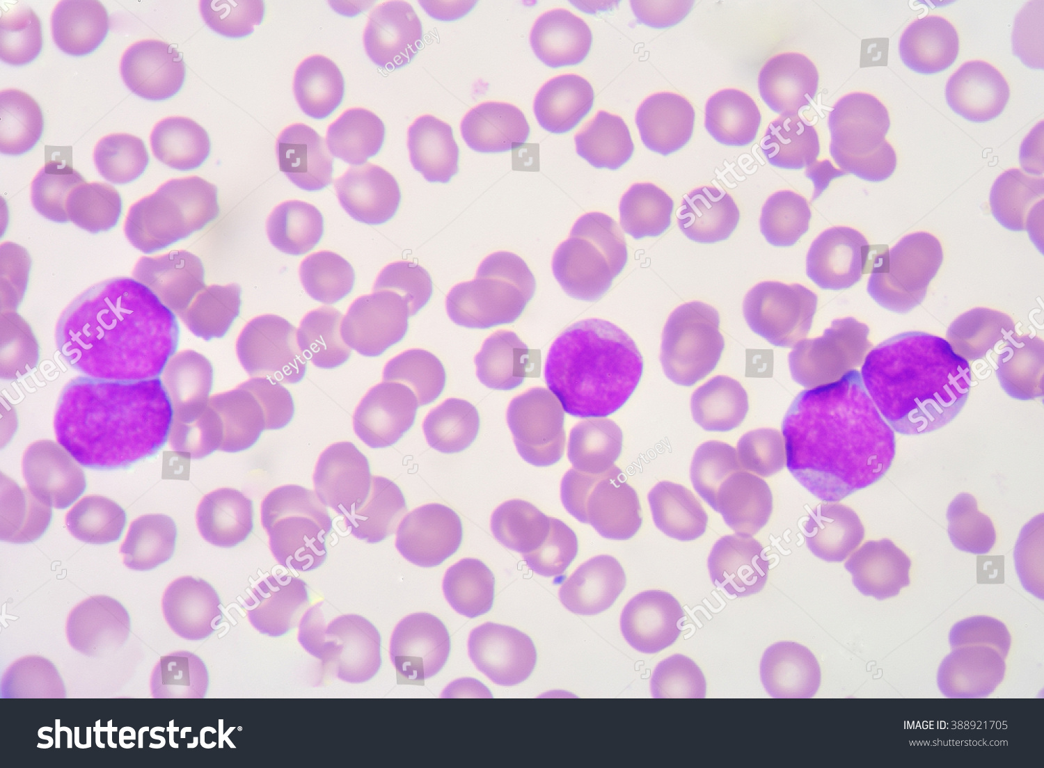 Blast Cell On Blood Smear Stock Photo 388921705 | Shutterstock