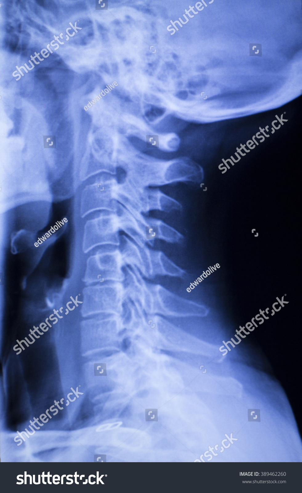 Skull Neck Spine Vertebra Shoulders Injury Stock Photo 389462260 ...