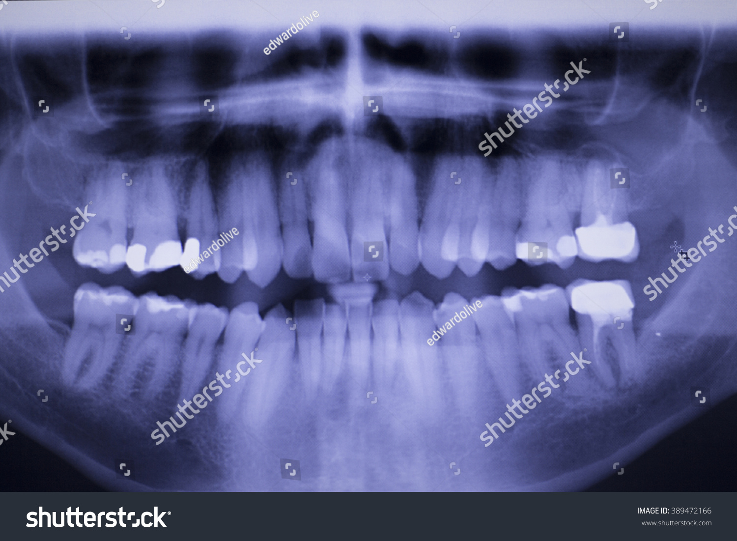 Dental Teeth Fillings Gum Disease Gingivitis Stock Photo 389472166 