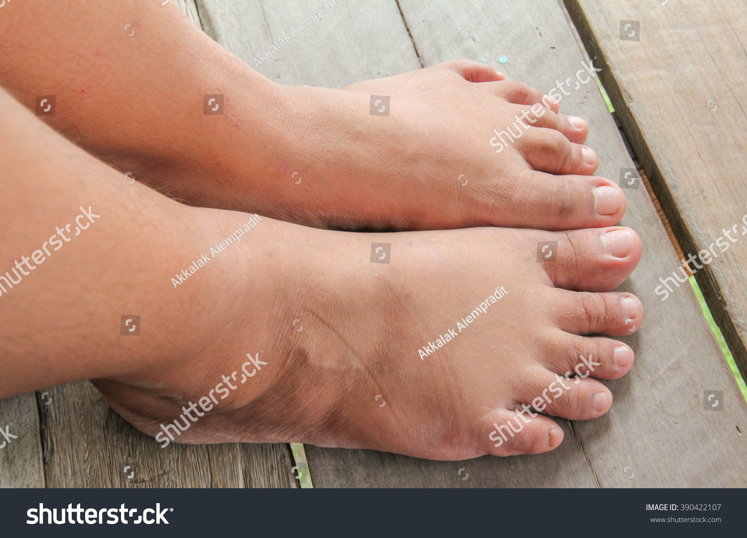 ковидные пальцы ног фото