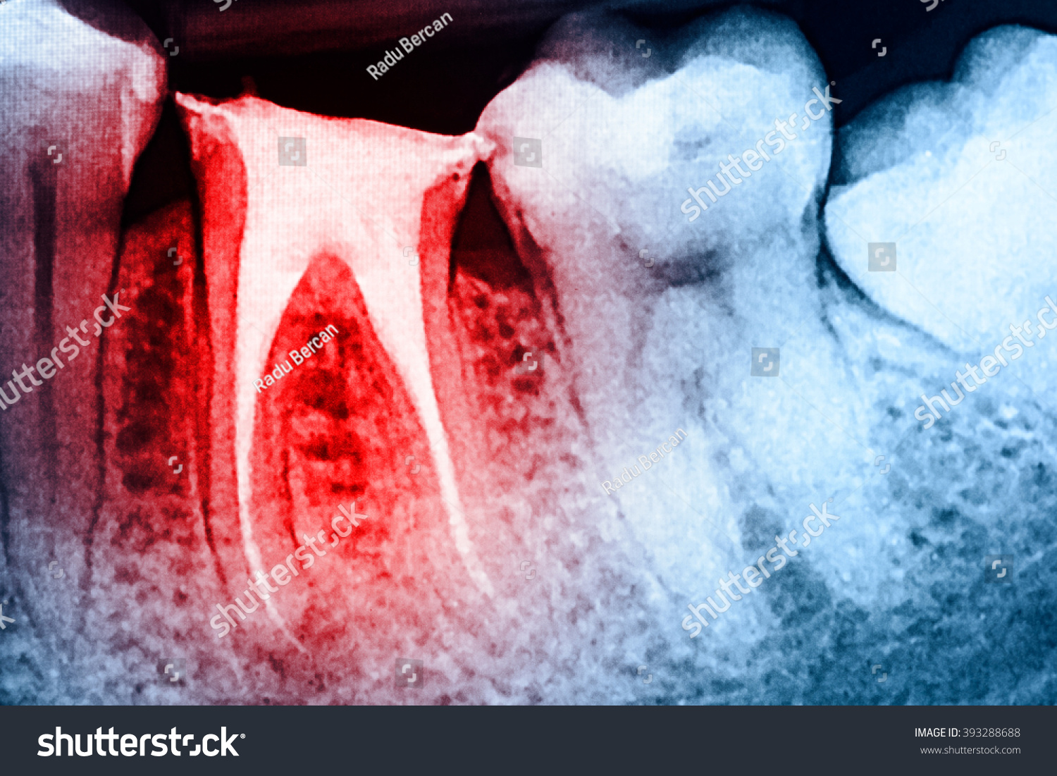 Full Obturation Root Canal Systems On Stock Photo 393288688 | Shutterstock