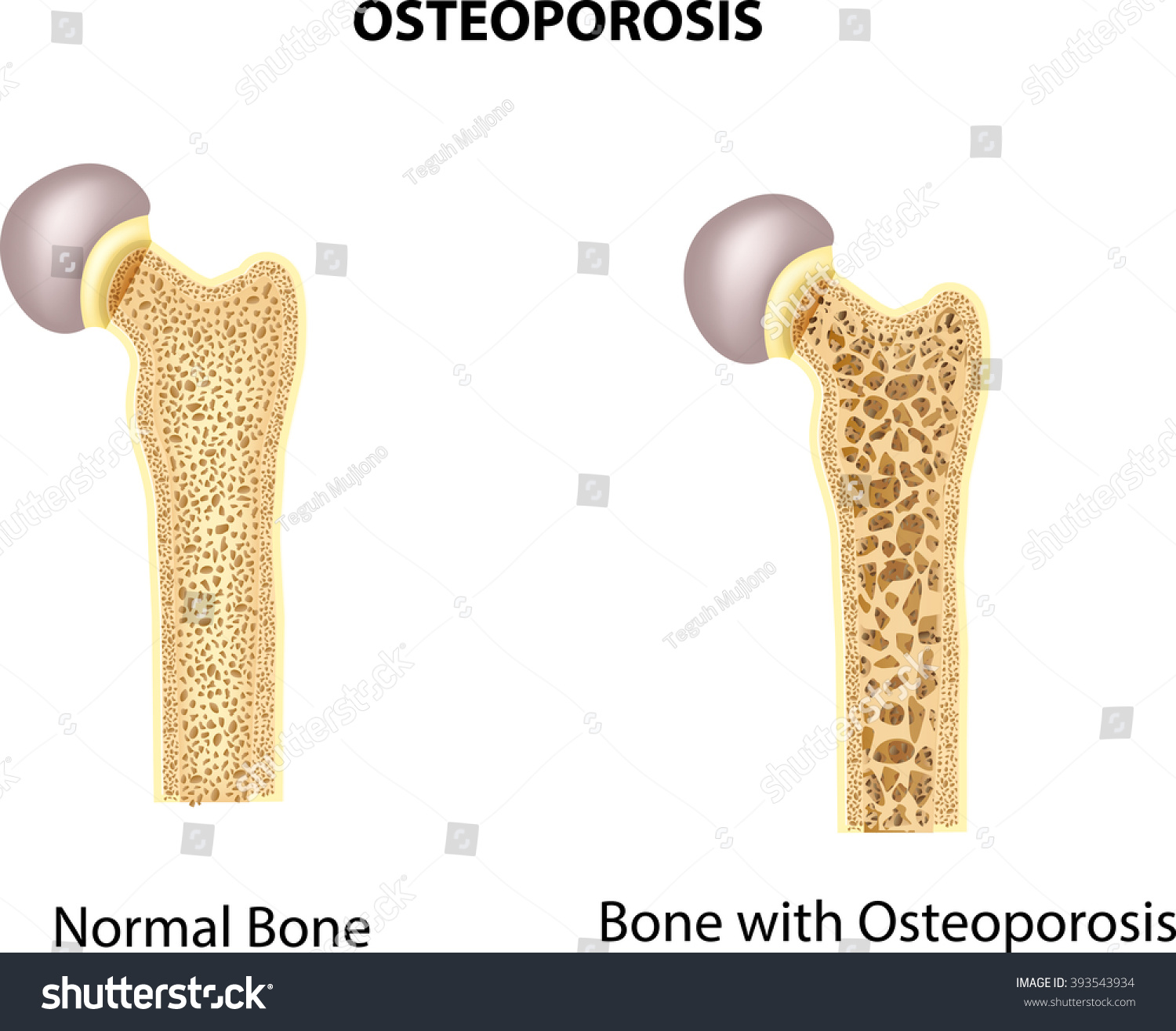 Illustration Bone Hip Normal Bone Bone Stock Illustration 393543934 ...