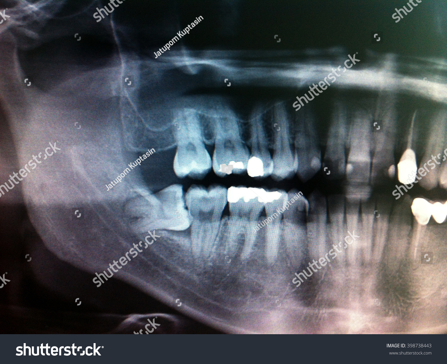 Dental Xray Shows Extract Wisdom Tooth Stock Photo 398738443 | Shutterstock