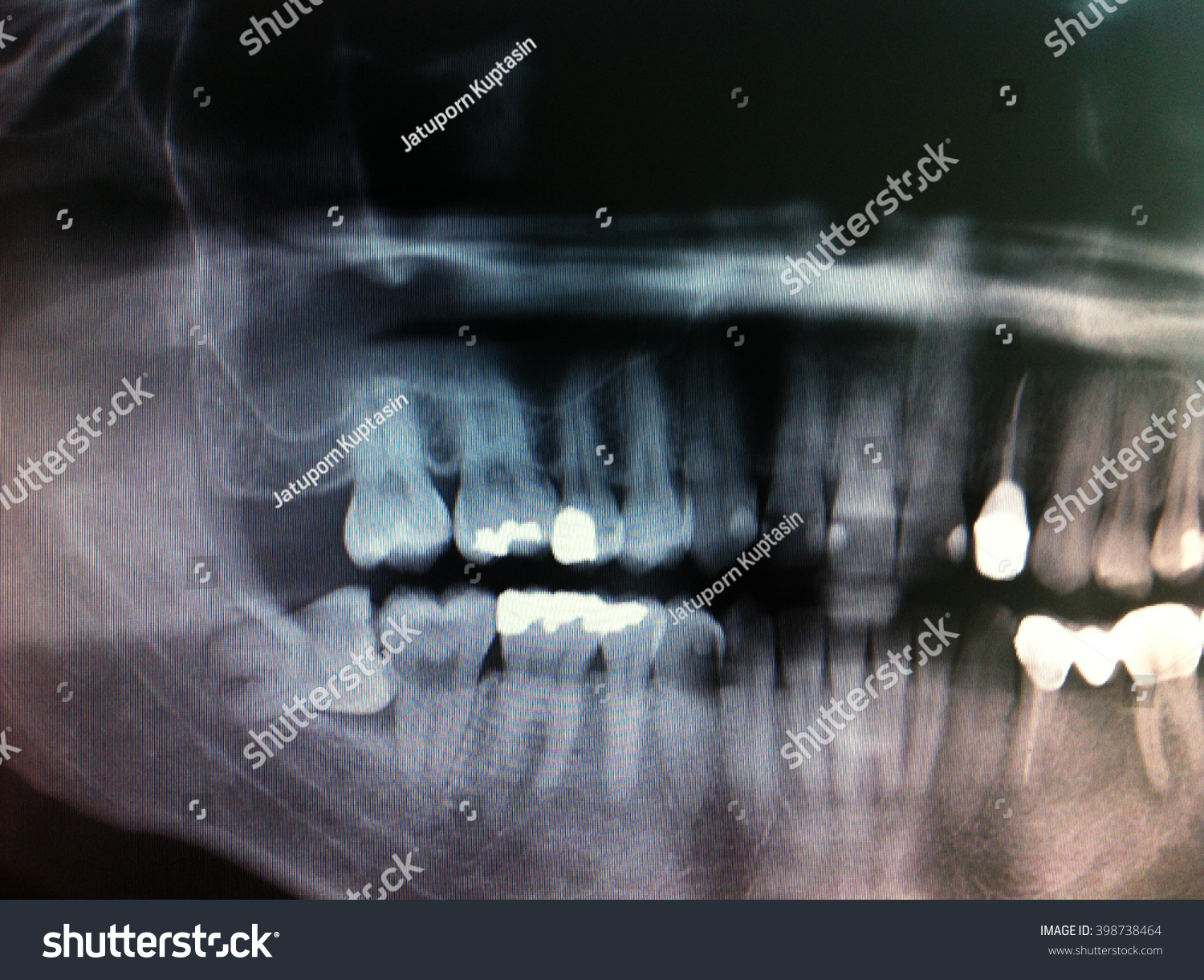 Dental Xray Shows Extract Wisdom Tooth Stock Photo 398738464 | Shutterstock