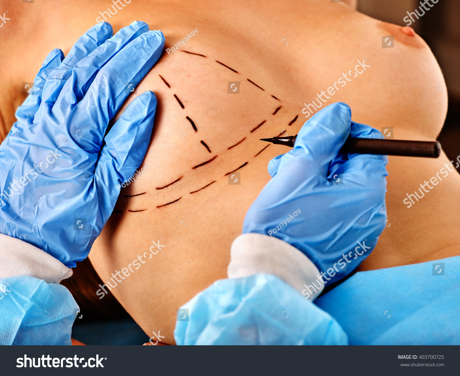 операция грудь женщин фото 5